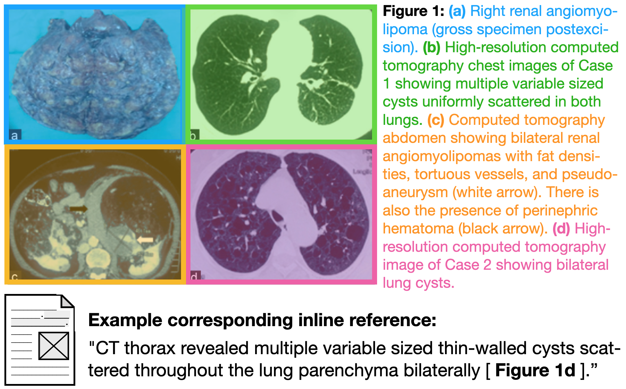 Figure 1: Example of color-coded subfigures and corresponding subcaptions (top), with an example inline reference from the full text. Figure and text adapted from [5].