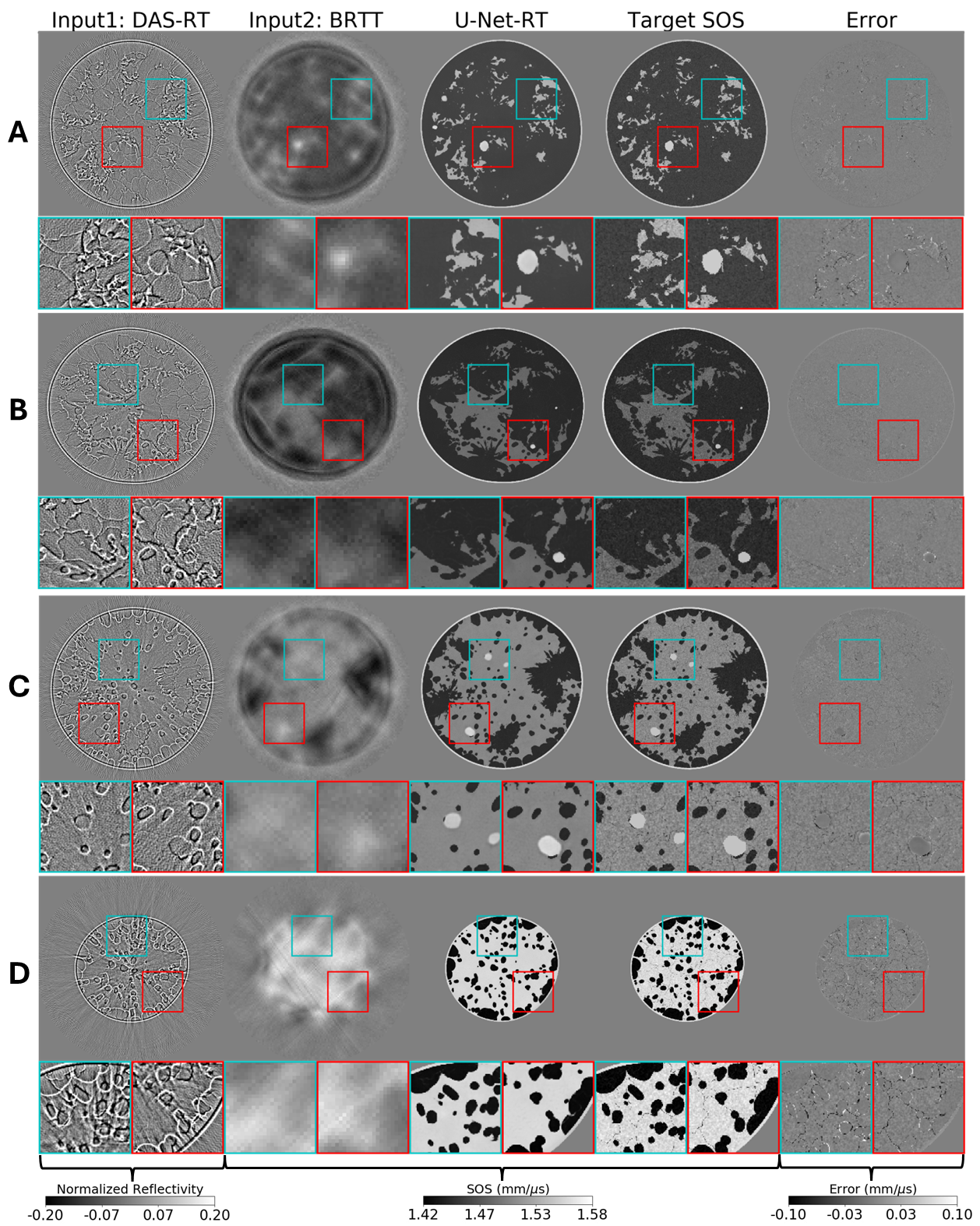 Figure 2: From left to right: Examples of a reflectivity map reconstructed by DAS-RT (scaled using its maximum absolute value), SOS map reconstructed by BRTT, SOS map produced by U-Net-RT, target SOS map, and the corresponding error map representing the difference between the target SOS map and the SOS map produced by U-Net-RT. Images were cropped to a window of size 124mm-by-124mm. From top to bottom: Results corresponding to NBPs representative of the four breast density types (A, B, C, D). Square insets highlight specific patches (25mm-by-25mm) within the images, with zoomed views shown below each image. DAS-RT and BRTT images, serving as inputs for U-Net-RT, contribute tissue boundary information and background SOS information, respectively, to the SOS map produced by U-Net-RT.
