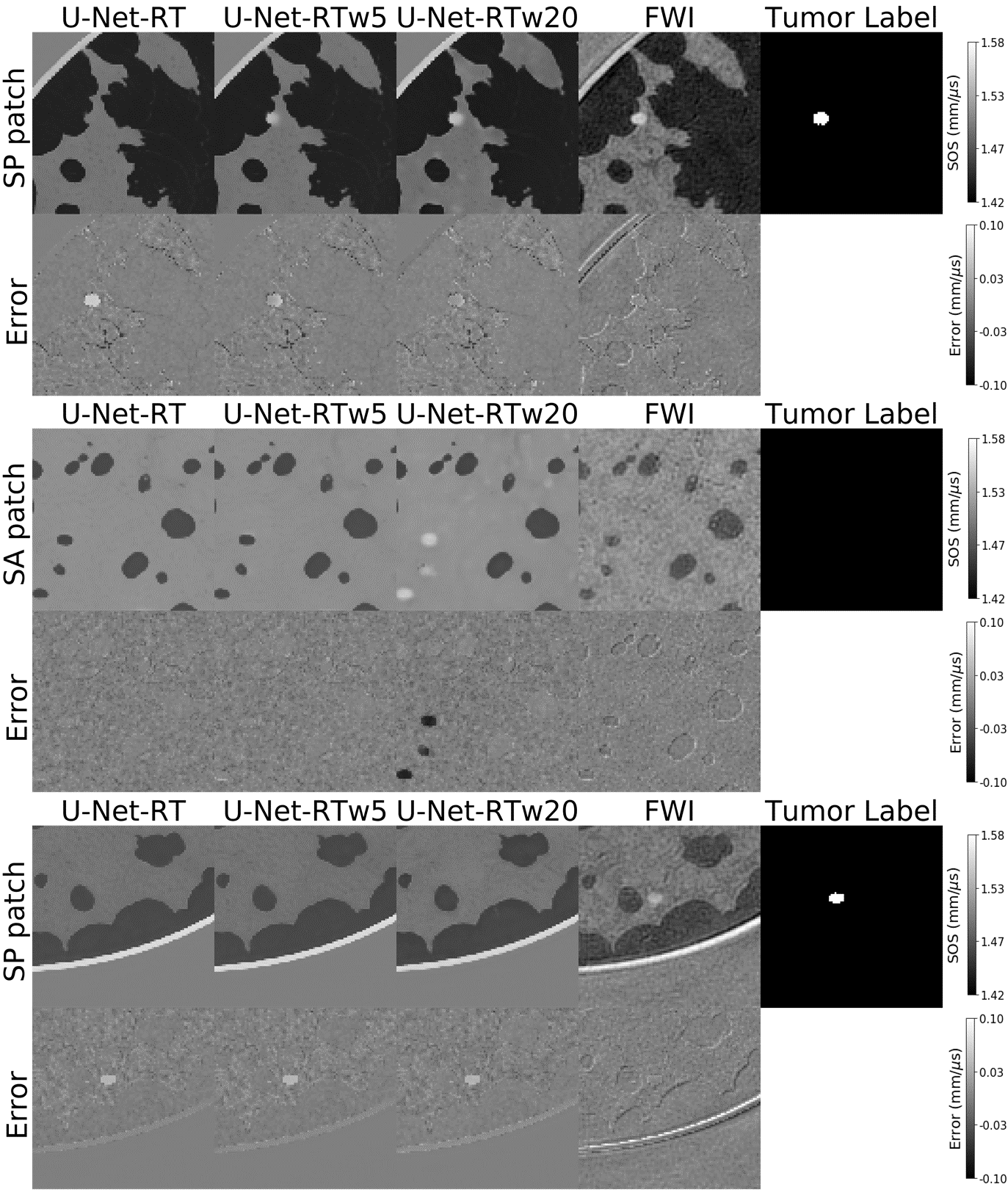 Figure 5: Three examples of 24mm-by-24mm patches from the testing dataset. From left to right: patches obtained from the SOS maps produced by U-Net-RT, U-Net-RTw5, U-Net-RTw20, and FWI, with the final column presenting the corresponding label map indicating tumor presence/absence. For each example, from top to bottom: SP or SA patch followed by the corresponding error map. The first row shows a case where the fine-tuned U-Net-RT models can resolve tumors while the standard U-Net-RT fails. The second row shows a case where the fine-tuned U-Net-RT with high weight values (U-Net-RTw20) can produce false positives. Finally, the third highlights the limited ability of the standard and fine-tuned U-Net-RT models to resolve the tumor when compared to FWI.