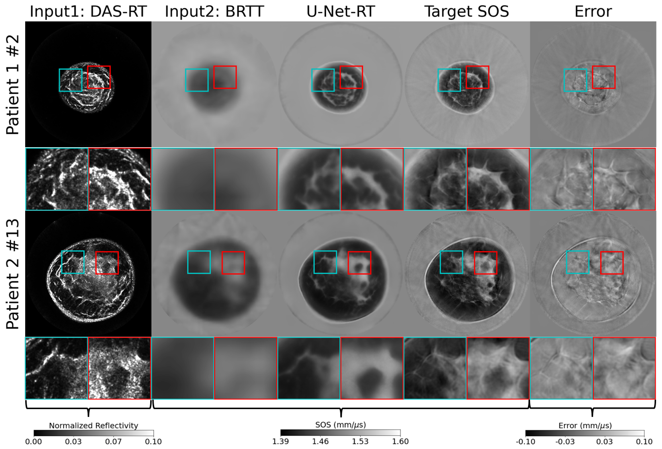 Figure 7: Application of the dual-modality IILR method to clinical USCT breast data. From left to right: reflectivity amplitude map reconstructed by DAS-RT (scaled using its maximum value), SOS maps reconstructed by BRTT, SOS map produced by U-Net-RT, target SOS map produced by FWI, and the corresponding error map representing the difference between the target SOS map and the SOS map produced by U-Net-RT. Each row represents a slice from a different patient. The rows are labeled as ‘Patient X \#Y’, where X is the patient number and Y is the slice number. Lower Y values indicate slices closer to the nipple. Each image represents a 212 mm-by-212 mm area. Square insets highlight specific patches (37.5mm-by-37.5mm) within the images, with zoomed views shown below each image. DAS-RT and BRTT images, serving as inputs for U-Net-RT, contribute tissue boundary information and background SOS information, respectively, to the SOS map produced by U-Net-RT.