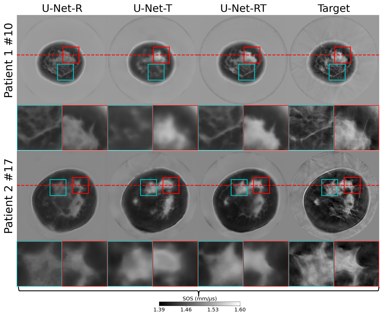 Figure 8: Comparison of the dual-modality and single-modality IILR methods using clinical USCT breast data. From left to right: SOS estimates produced by the U-Net-R, U-Net-T, U-Net-RT, and FWI (target SOS). Each row represents a slice from a different patient. The rows are labeled as ‘Patient X \#Y’, where X is the patient number and Y is the slice number. Lower Y values indicate slices closer to the nipple. Each image represents a 212 mm-by-212 mm area. Square insets highlight specific patches (37.5mm-by-37.5mm) within the images, with zoomed views shown below each image. The red dashed lines in the two testing cases indicate the locations of the line profiles shown in Fig. 9. While U-Net-RT and U-Net-R exhibit similar tissue structures due to the DAS-RT input informing boundary locations and shapes, U-Net-R shows significant bias in high-SOS regions, and U-Net-T is more prone to missing fine details.