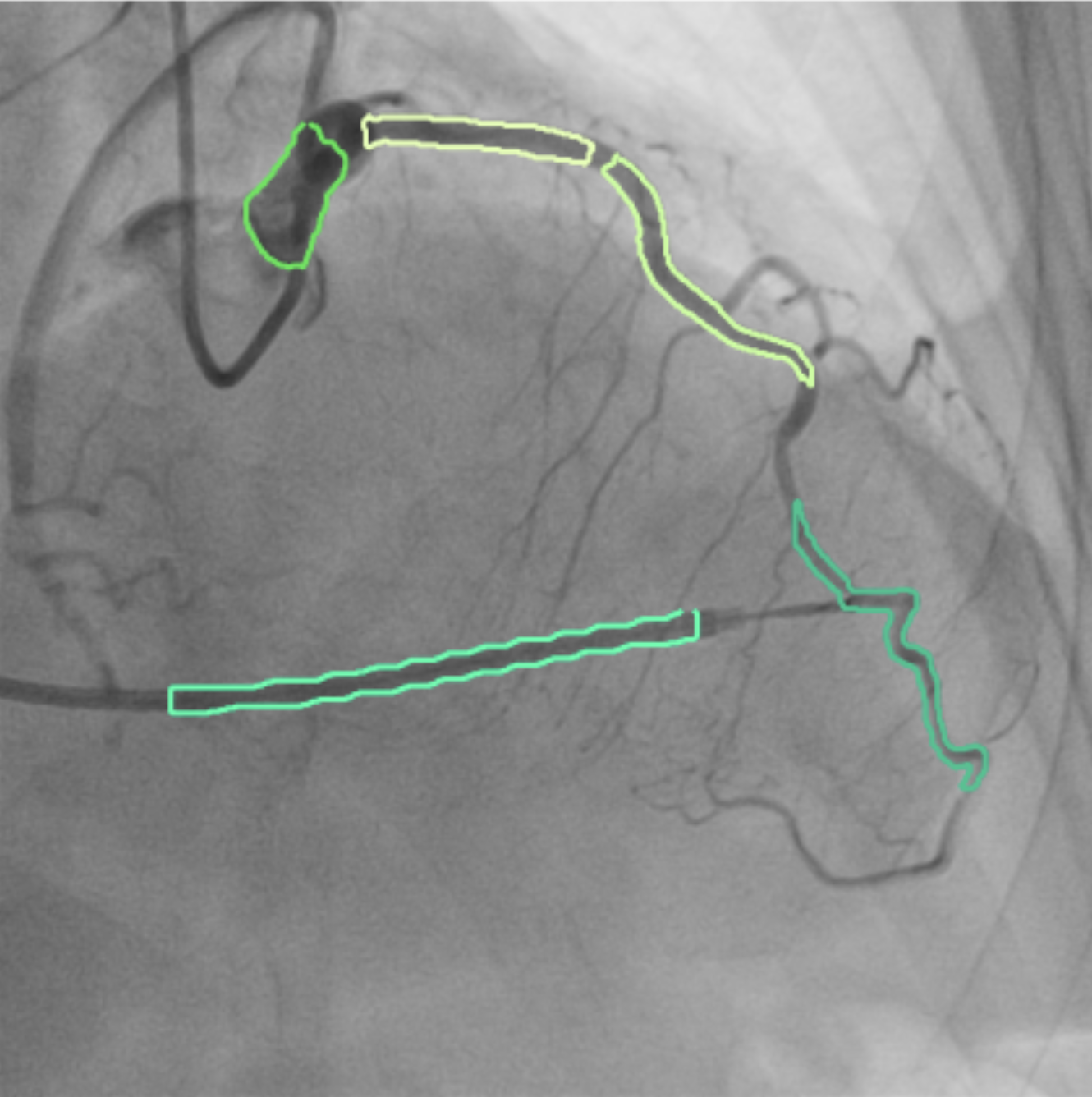 Figure 4: An example of misidentified RCA segment in LCA. When a guide wire is located in a similar position to RCA, the segmentation model may recognize the guide wire as a segment of RCA.