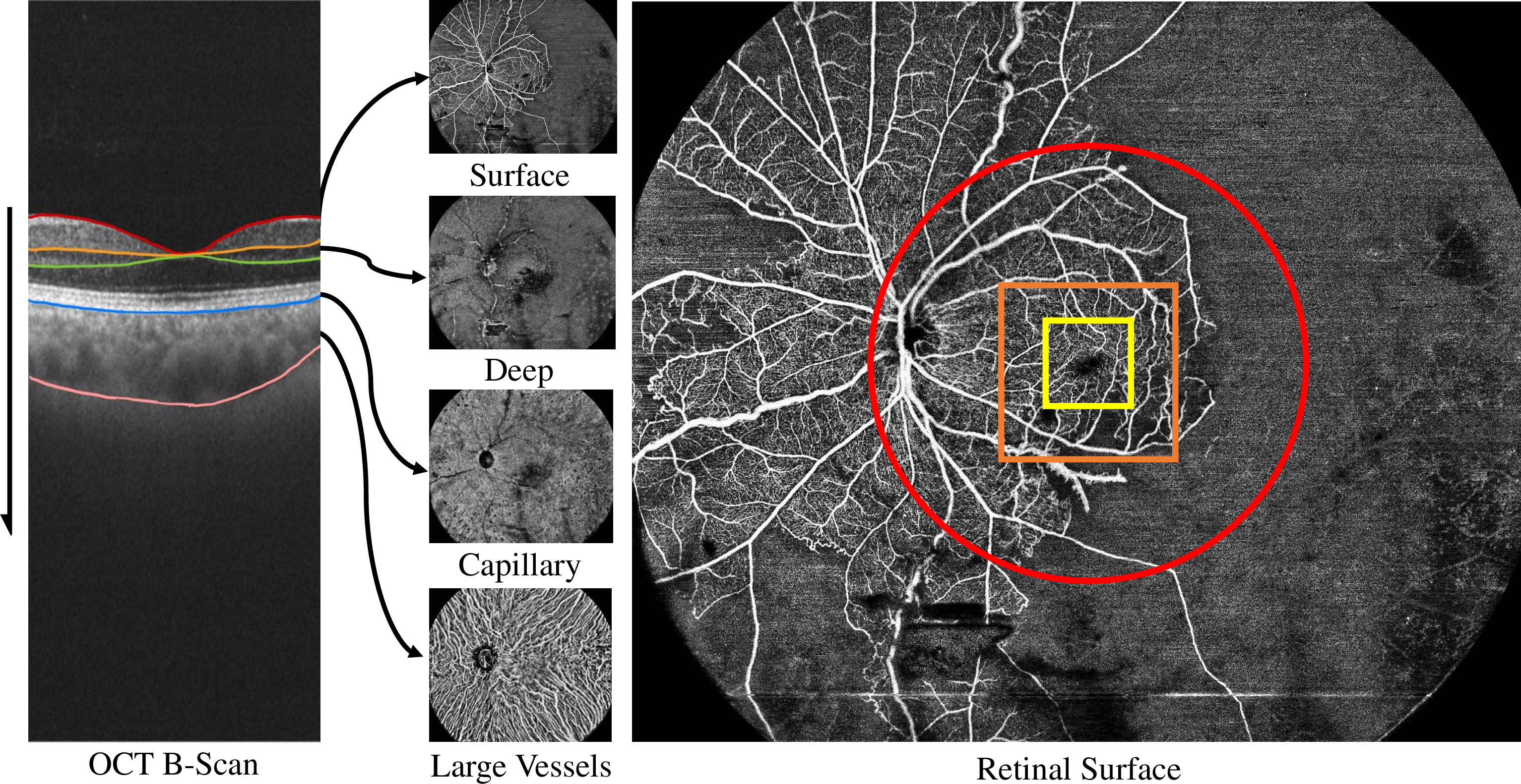 Figure 1: Illustration of proposed M3OCTA Dataset. The selected four-modal sample, scanned in 24 x 20 mm^{2}, contains four layer projection maps: retinal surface (inner limiting membrane-the inner plexiform layer), retinal deep (the inner plexiform layer-the outer plexiform layer), choroid capillary (bruch’s membrane) and choroid large vessel (choroid layer) (The vertical arrow denotes the projection direction). The red, orange, and yellow regions denote the scan region of the regular fundus, 3\times3mm, and 6\times6mm OCTA image.