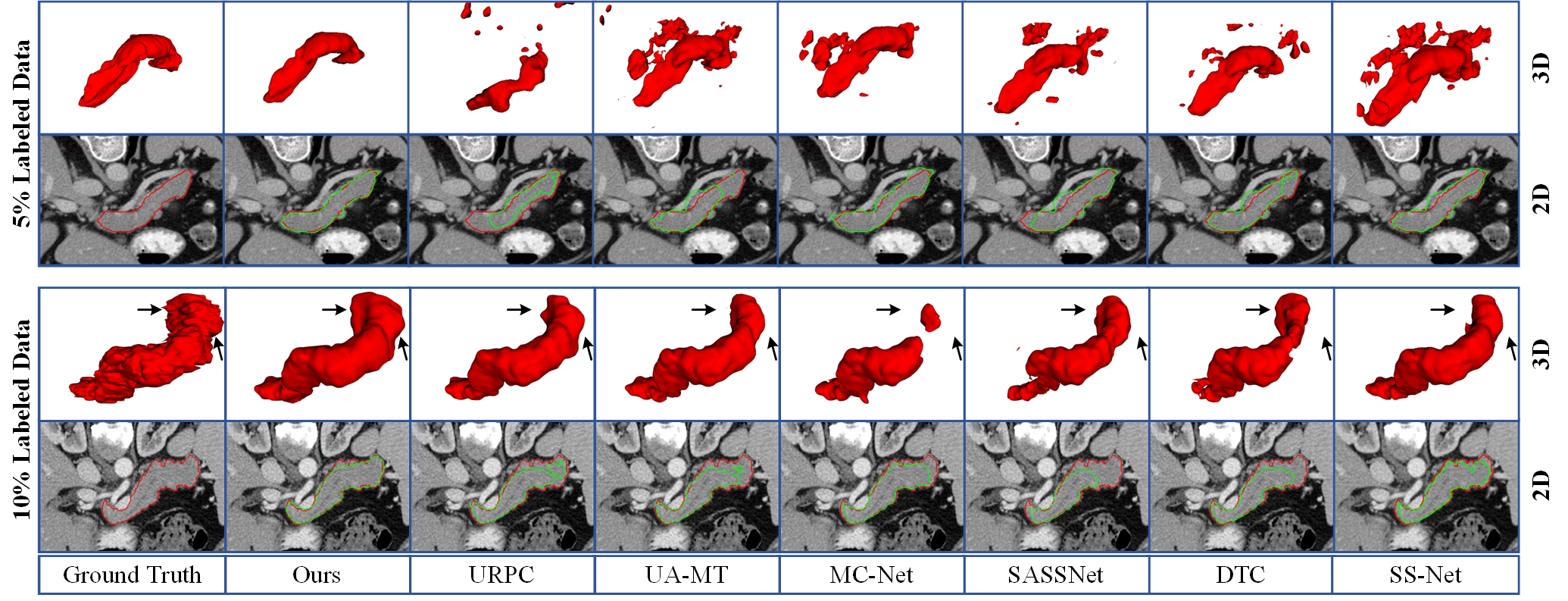 Figure 5: 2D and 3D Visualization with other methods on the Pancreas-CT dataset under 5\% labeled data and 10\% labeled data. The red lines denote the boundary of ground truth and the green lines denote the boundary of predictions.