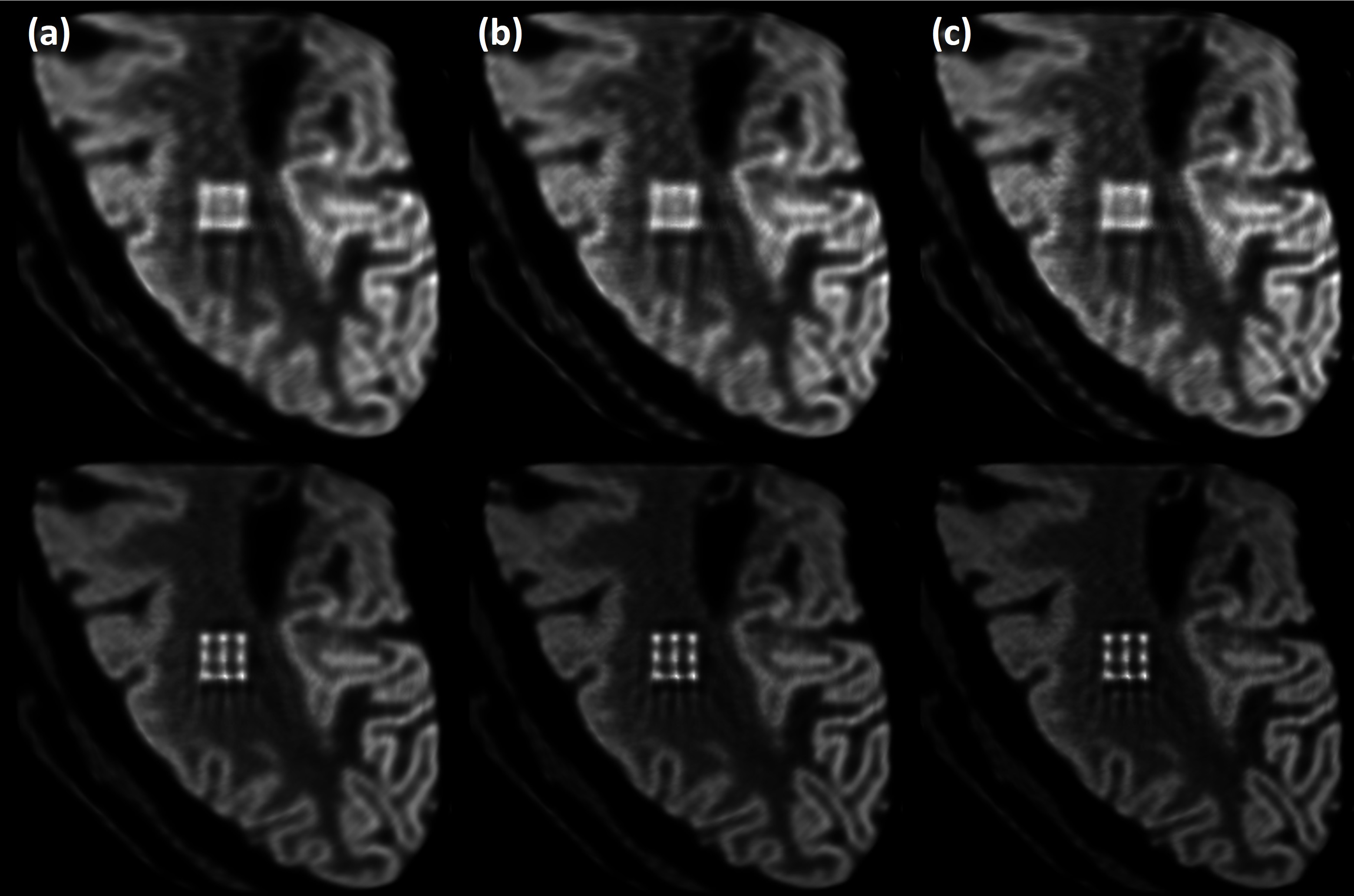 Figure 12: Noise-free images obtained for the brain phantom by M0 (top) and M2 (bottom), using 50 (a), 100 (b), and 200 (c) OSEM iterations. Analytical methods were used for data generation and image reconstruction.