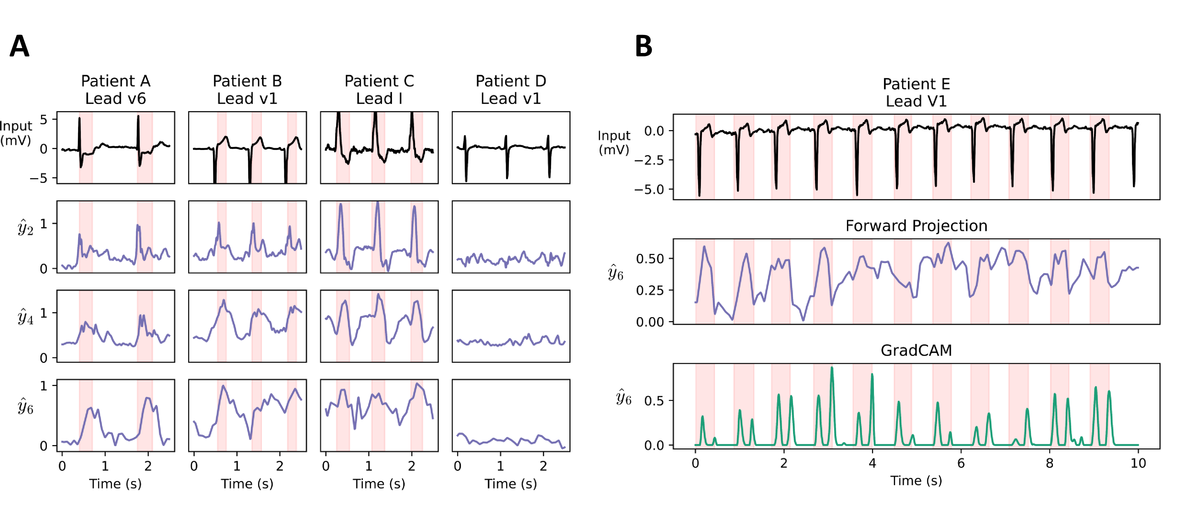 Figure 3: Forward Projection layer interpretions for electrocardiogram analysis. A: Visualisation of layer explanations over time in a 1D-convolutional neural network trained by Forward Projection to detect myocardial infarction (MI) in electrocardiograms (ECGs) from PTBXL data. Patients A, B, C, E (diagnosed MI) and patient D (no disease) were extracted from test data. Explanations were extracted from the second, fourth and sixth convolutional layers (\hat{y}_2,\hat{y}_4,\hat{y}_6) using equation 3 . Explanations increase with MI features (highlighted in red), including ST-segment depression (Patient A), ST-segment elevation (Patient B) and QRS widening with T-wave inversion (Patient C). B: Comparison of Forward Projection with GradCAM. Top: ECG data from Patient E (diagnosed MI), showing ST-segment elevation. Middle: Sixth convolutional layer explanation (\hat{y}_6) from a model trained by Forward Projection. Below: GradCAM output for the sixth convolutional layer of a model trained by backpropagation.