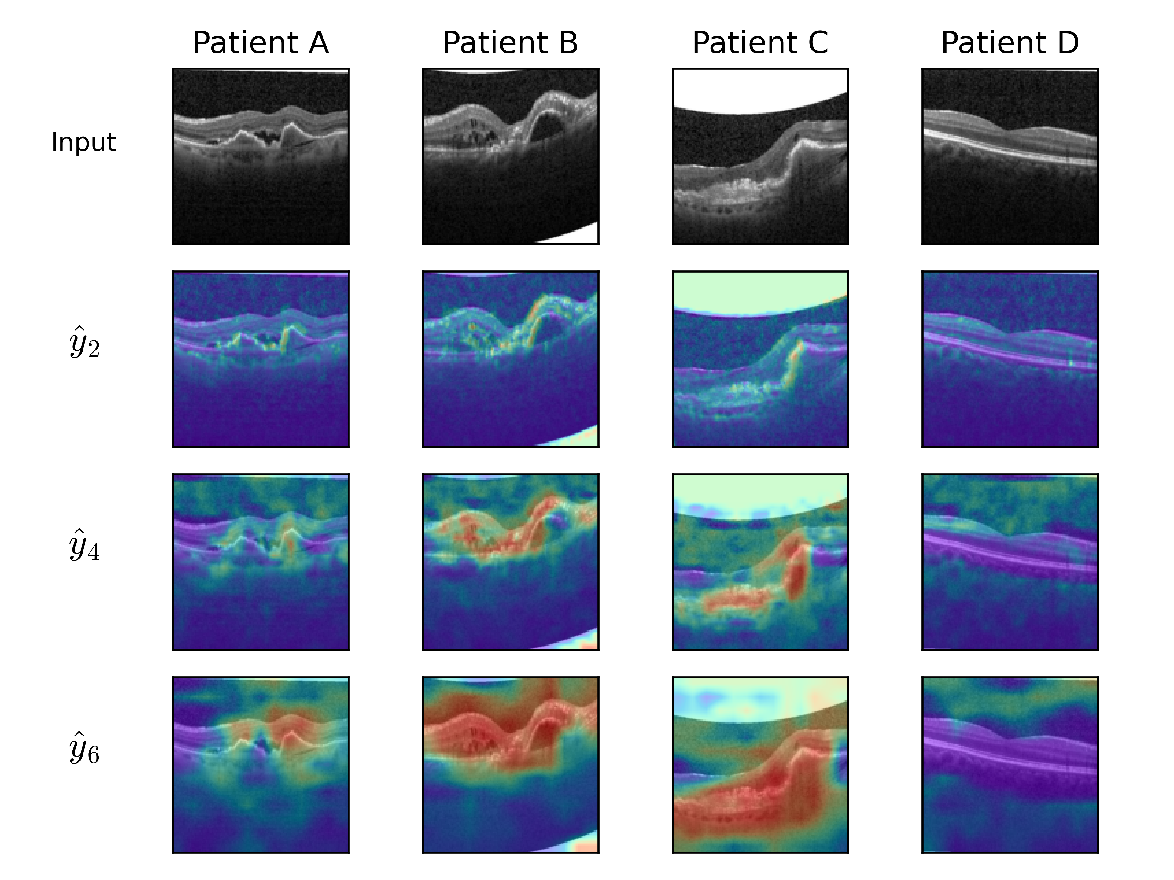 Figure 4: Visualisation of layer explanations over space in 2D-CNNs trained by Forward Projection to detect choroid neovascularization (CNV) in the OCT task. Ensemble average of five models shown. Patients A-C (diagnosed CNV) and patient D (no disease) were extracted from test data. Explanations were extracted from the second, fourth and sixth convolutional layers (\hat{y}_2,\hat{y}_4,\hat{y}_6), using 3 . CNV heat-maps demonstrate high values (red) over CNV features, including retinal/subretinal fluid (Patients A-C) and hard exudates (Patient B), and fibrosis (Patient C), with low values (blue) over healthy retina (Patient D).