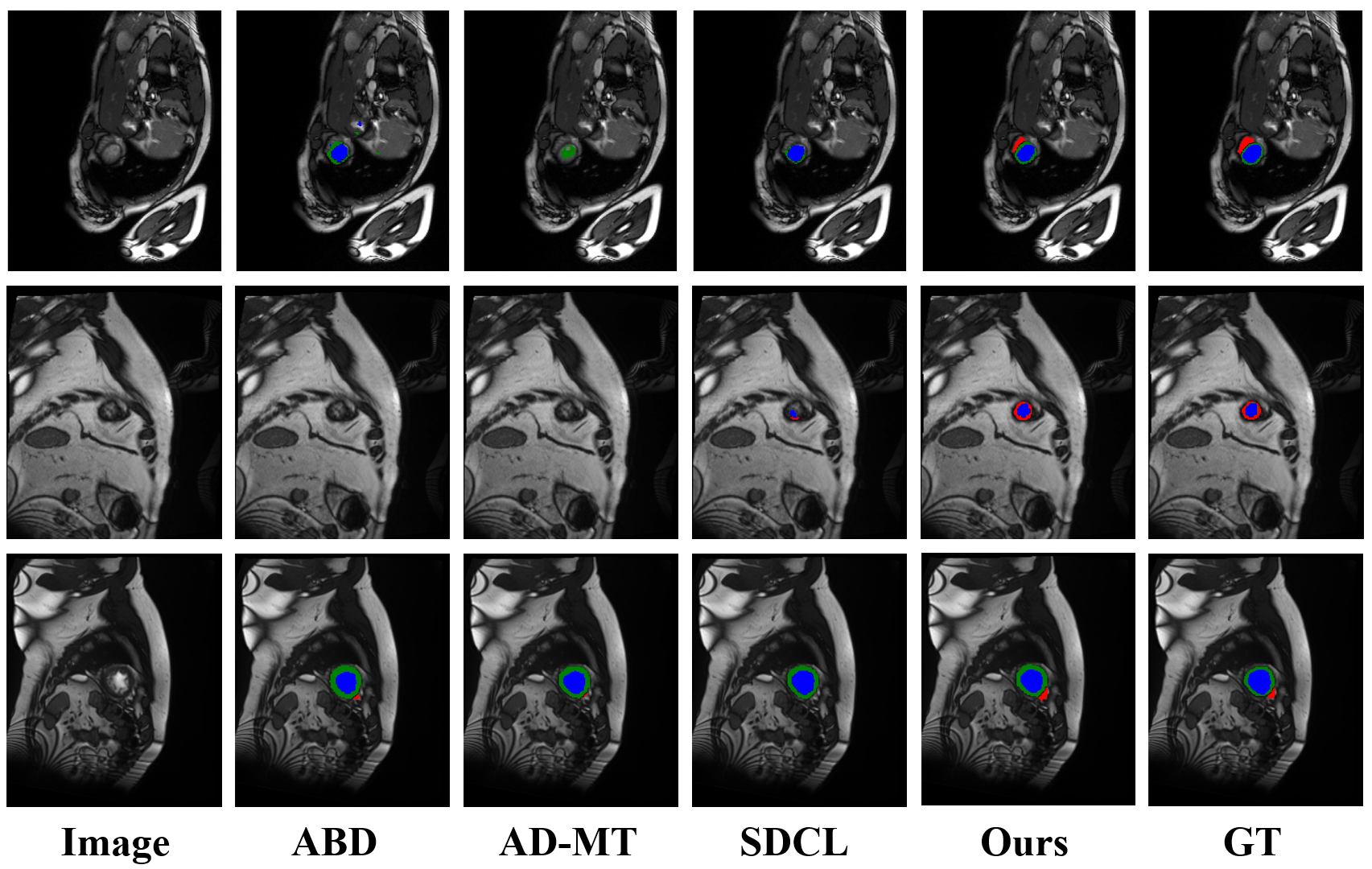Figure 3: Representative segmentation results on the ACDC dataset using the 10% labeled data. The proposed method produces segmentations that align more closely with the ground truth than competing approaches, demonstrating superior performance in capturing complex, fine-grained structures. Notably, in the red-highlighted region, only DTSL achieves an accurate segmentation.
