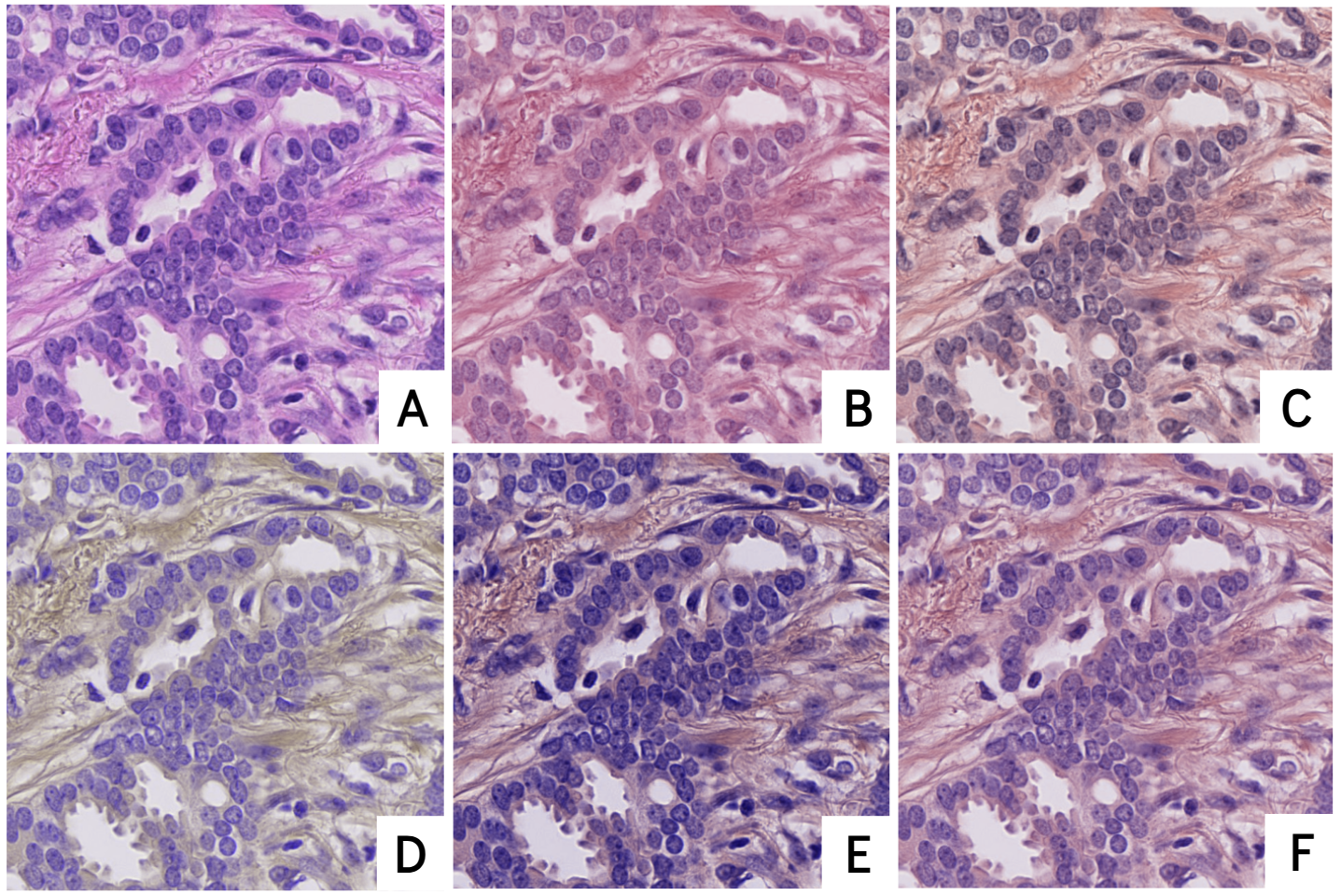 Figure 1: Illustration of the augmentation workflow. (A) Example of a raw 640 \times 640 H&E tile extracted from an ROI. (B–F) Stain-normalized variants generated using a multi-target Macenko normalizer, mimicking natural staining variability across domains.