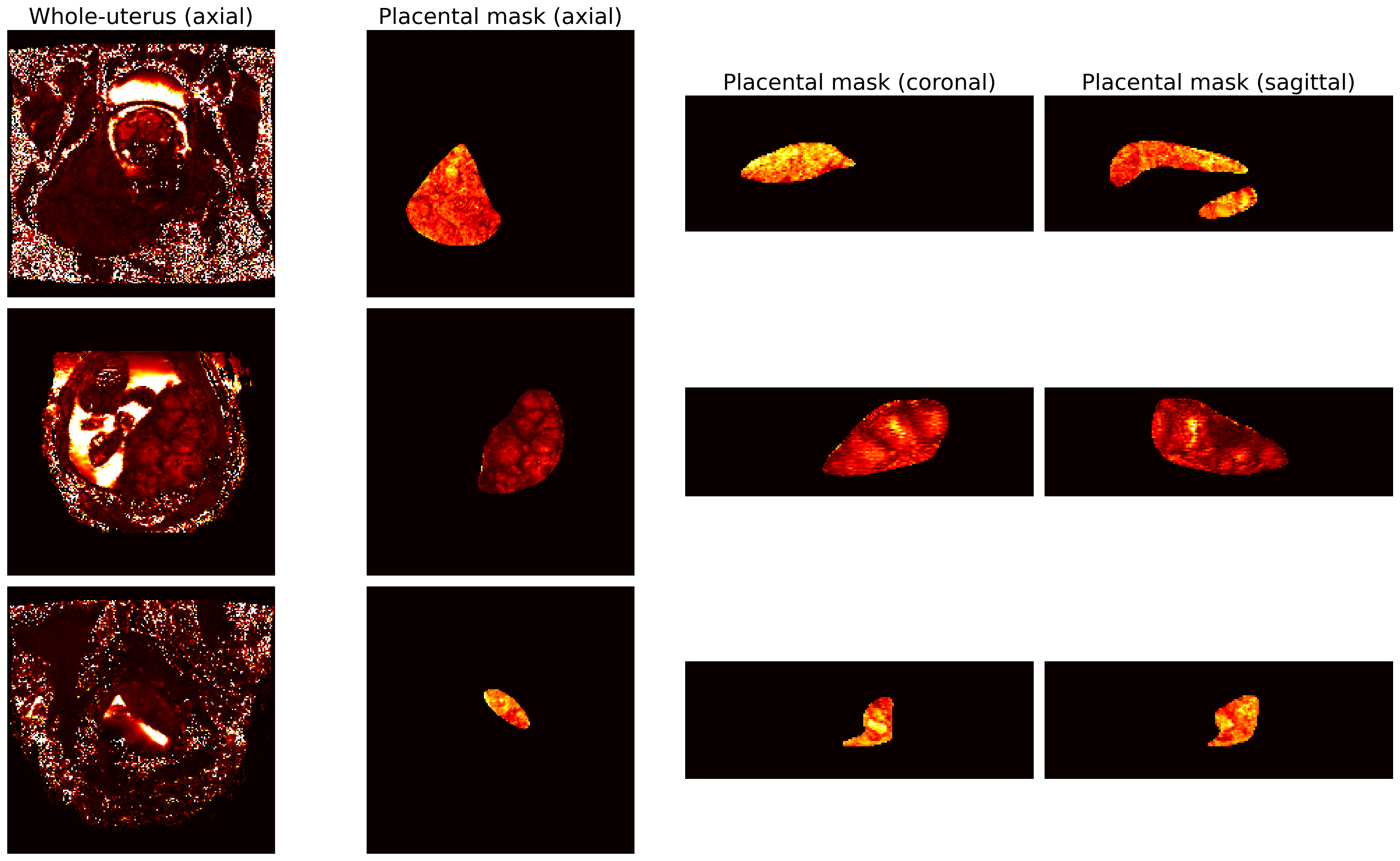 Figure 1: Example T2* MR images from the dataset, illustrating the heterogeneity of whole-uterus volumes (left column) and corresponding masked placentas (axial, coronal, and sagittal views; center and right columns). Substantial variation is observed in placental size, shape, and positioning across subjects, reflecting the diversity and complexity of the study dataset.