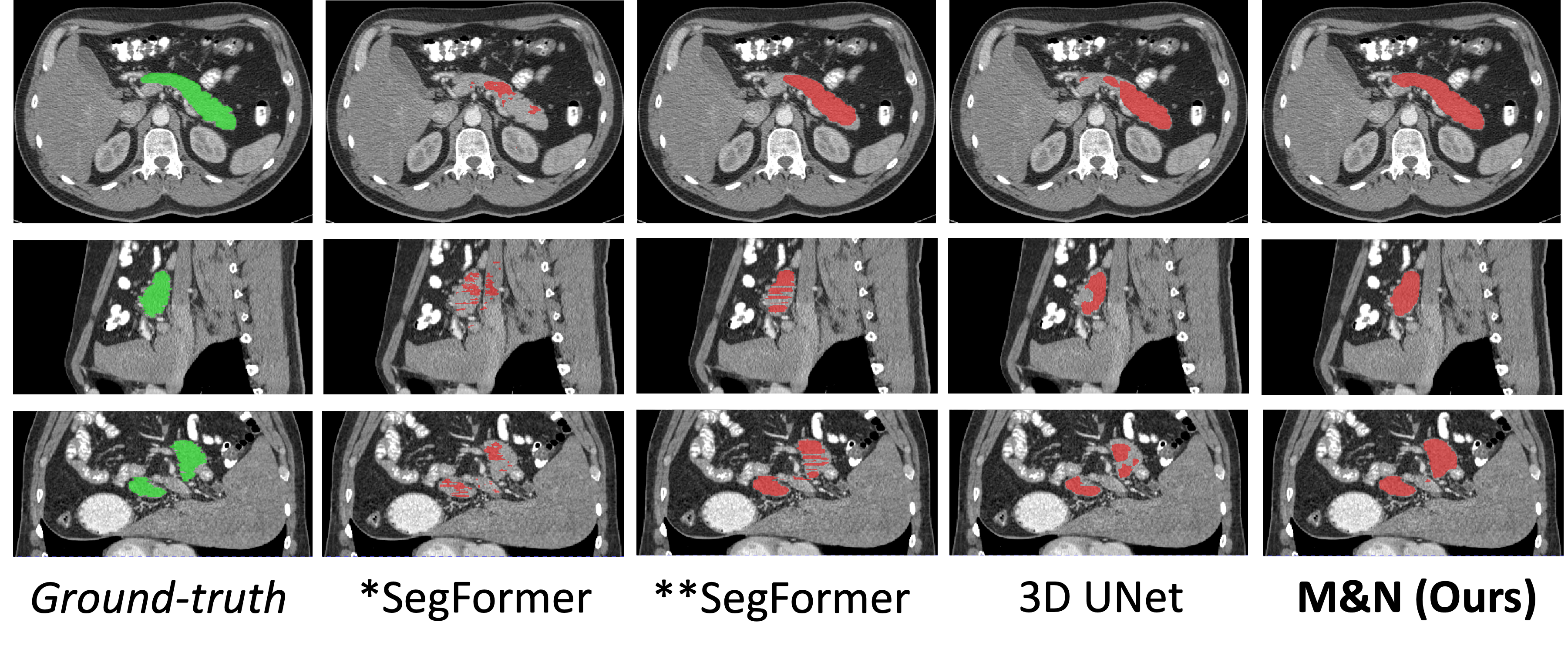 Figure 2: Qualitative results of Pancreas-CT dataset [21]. All approaches are trained from the same number (i.e. 6) of labeled images.*SegFormer is trained from scratch and **SegFormer is first pretrained on ADE20K [2].