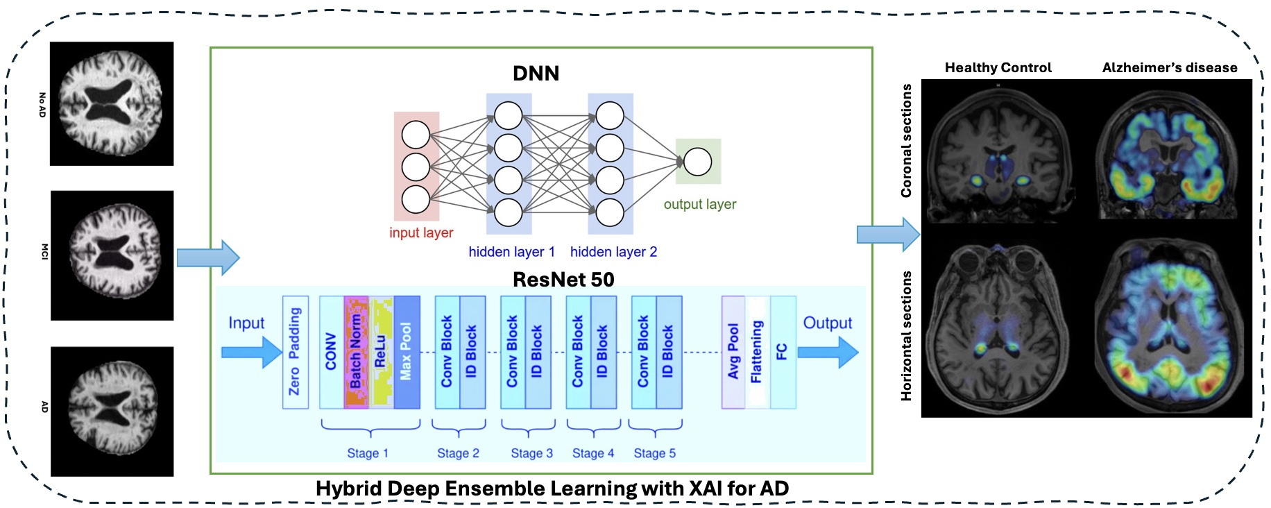 Figure 1: Hybrid deep ensemble learning framework with XAI using ResNet-50 and a dense meta-learner for Alzheimer’s Disease classification. Grad-CAM highlights key brain regions in both coronal and horizontal MRI sections distinguishing healthy control from Alzheimer’s patients.