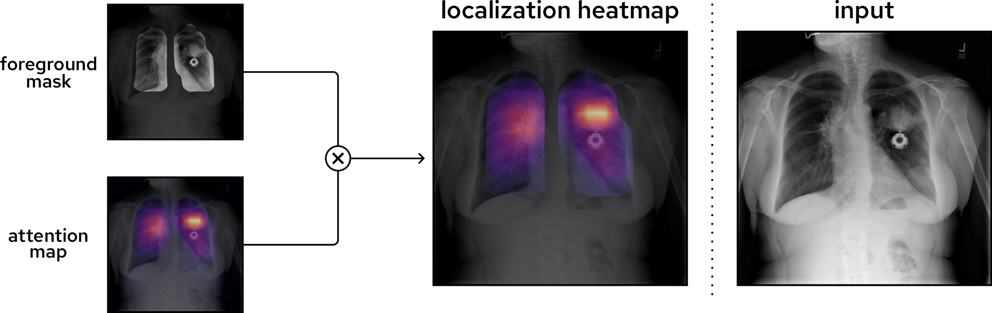 Figure 3: Weakly-supervised localization method of CLARiTy. During inference, a foreground mask and attention map are produced for each class. Element-wise multiplication yields a class-specific localization heatmap that is both highly precise and confined to the class’ ground truth region. In this example chest X-ray, a mass (round opacity) is found in the upper-middle left lung of the patient. The attention map has high intensity directly over the mass, and the heatmap intensity is confined to the lung lobes.