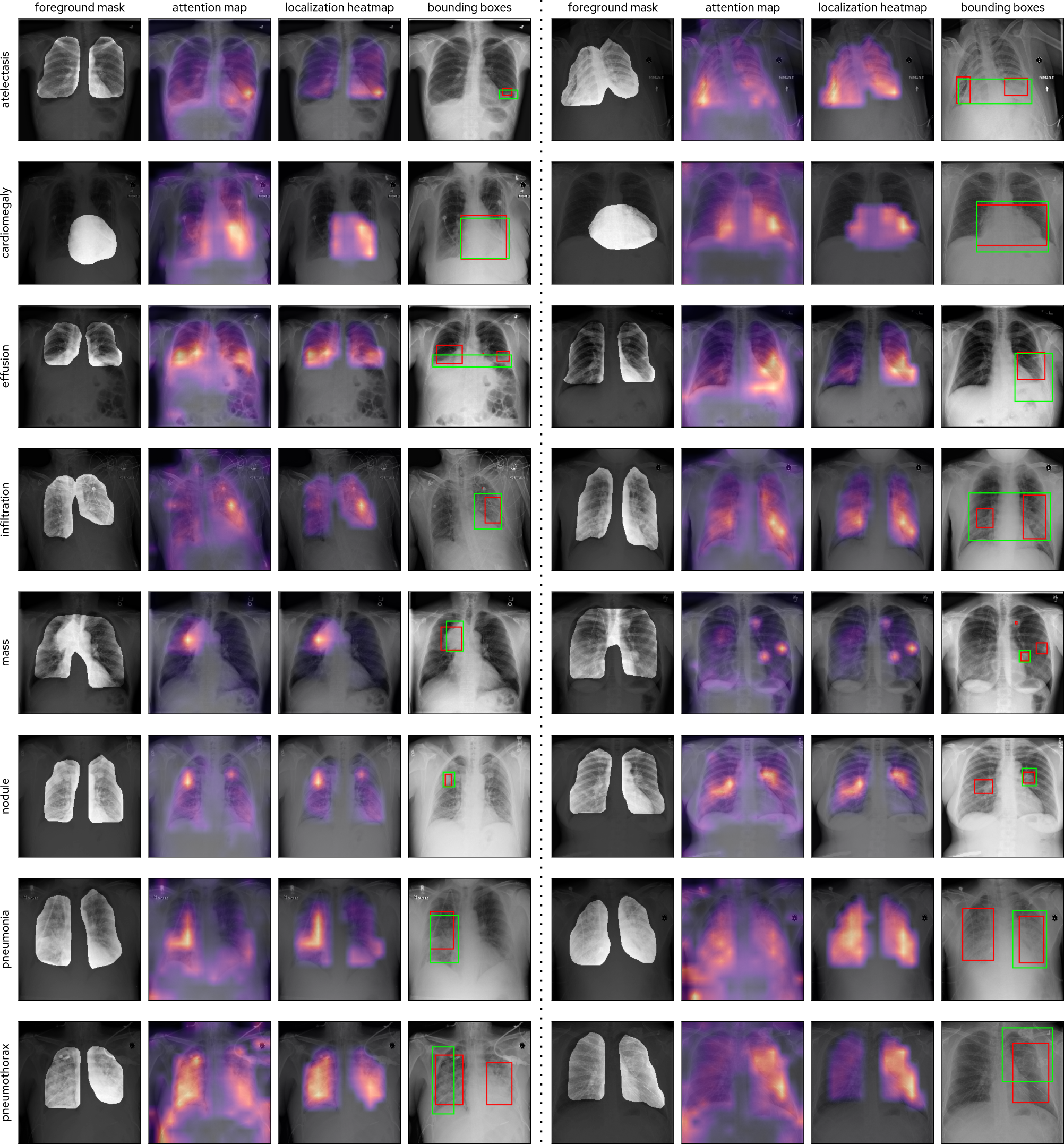 Figure 9: Selected localization outputs from the CLARiTy-S-16-224. For each pathology, two chest X-rays at 224 \times 224 are shown. All chest X-rays belong to the localization-test set. The model correctly predicted the presence of the pathology in each image. Class-specific outputs: foreground mask, attention map, localization heatmap, and bounding boxes. Each output is overlaid on the input chest X-ray. Ground-truth bounding boxes: green. Predicted bounding boxes: red.