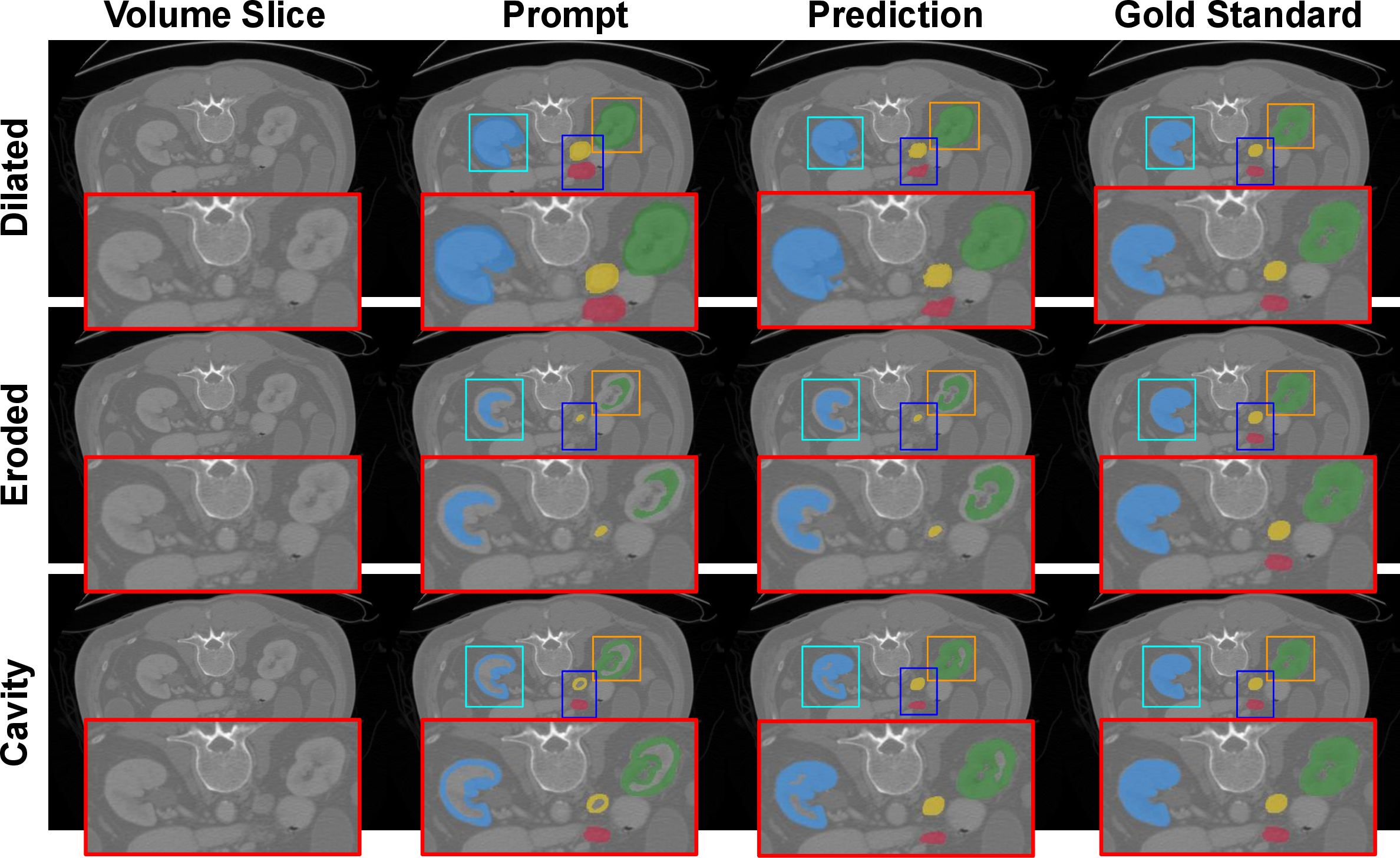 Figure 2: Qualitative results of nnInteractive for different prompt perturbations. Inset shows zoomed-in regions containing the organs, their perturbed prompts, predictions and the gold standard. As can be seen, the model over- and under-segments for dilated and eroded prompts, while it is more reliable when the prompt has bounding voxels (“Cavity”).