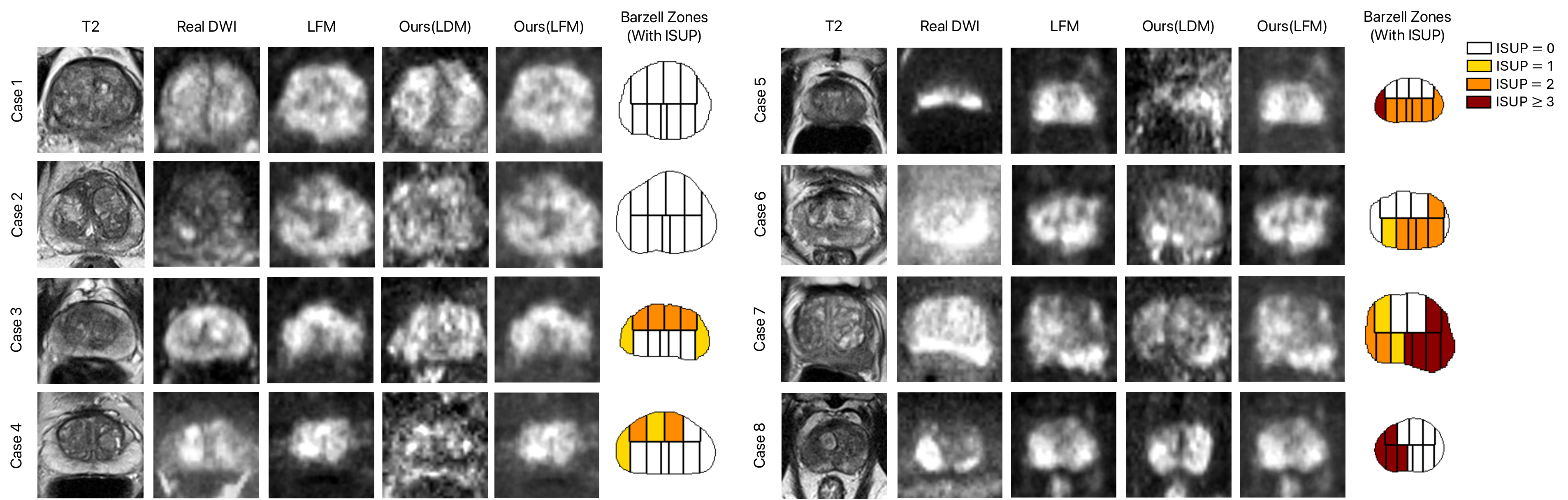 Figure 4: Samples of T2w images, corresponding real DWI, and DWI synthesized by pretrained LFM, Ours(LDM), and Ours(LFM). The rightmost column shows the corresponding Barzell zone labels by ISUP grade, where white denotes ISUP=​0, yellow denotes ISUP=​1, orange denotes ISUP=​2, and red denotes ISUP\ge​3.