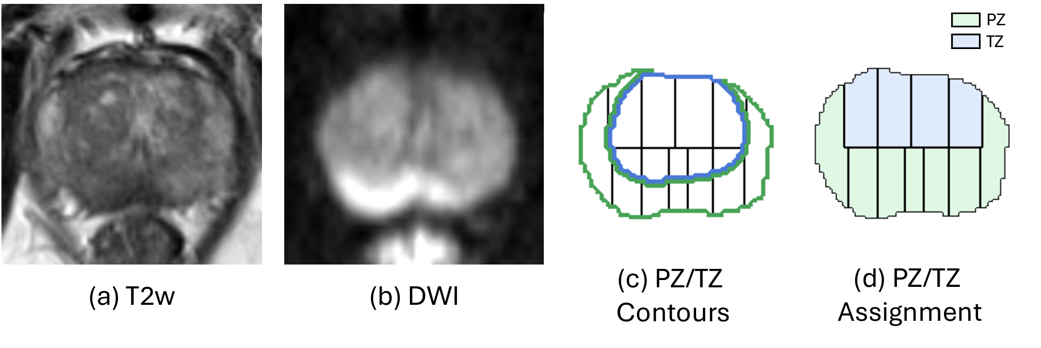 Figure 3: Assignment of Barzell zones to the PZ or TZ. (a) T2w. (b) DWI. (c) PZ/TZ contours overlaid on Barzell zones. (d) Final assignment based on the majority overlap rule.