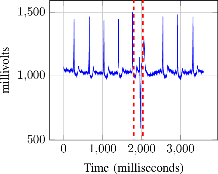 Figure 3: PVC ECG with approximate location marked between red lines.