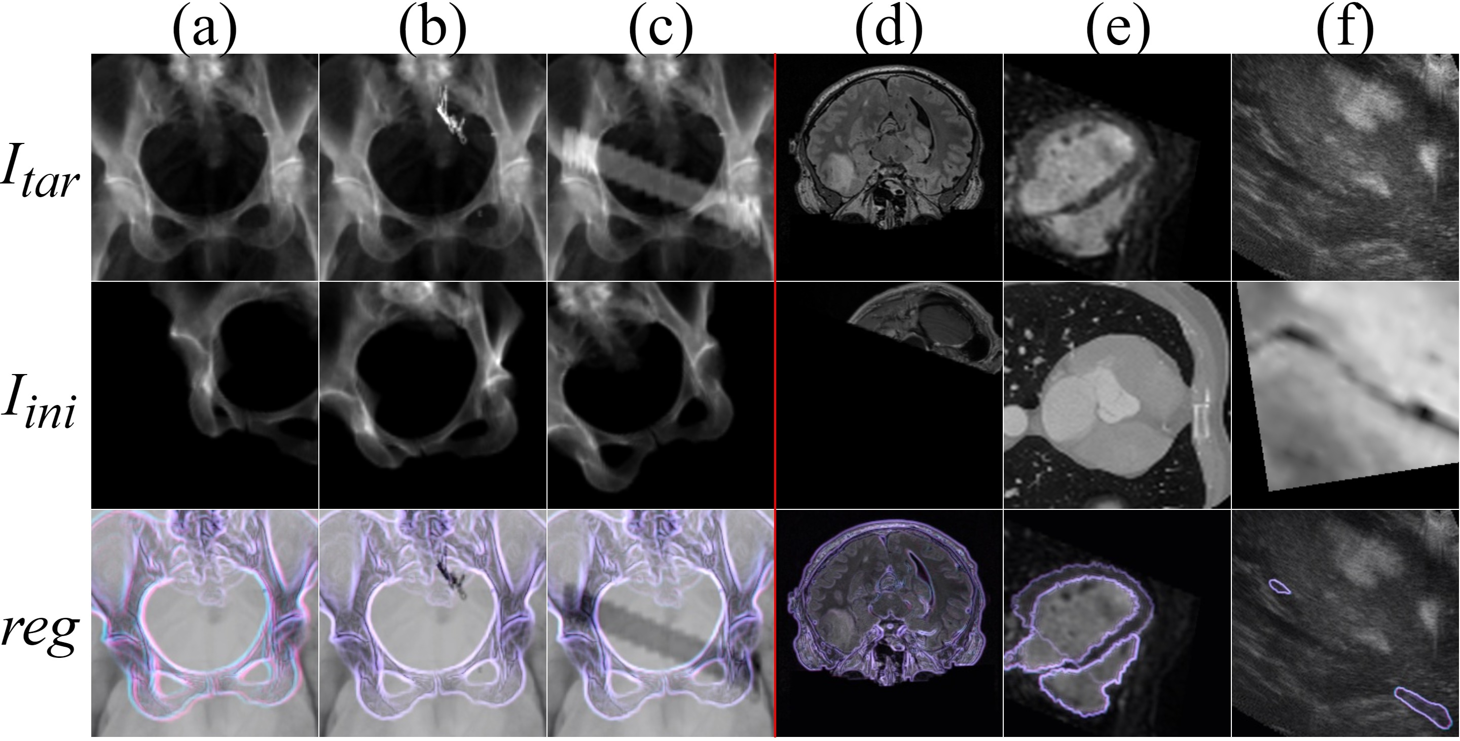 Figure 6: Registration performance of LayersReg across various application scenarios: (a) large displacement, (b) occlusion by pedicle screw, (c) occlusion type 2, (d) FLAIR-T1 brain MRI, (e) MRI-CT ventricle, (f) intraoperative craniotomy ultrasound to preoperative MRI registration.
