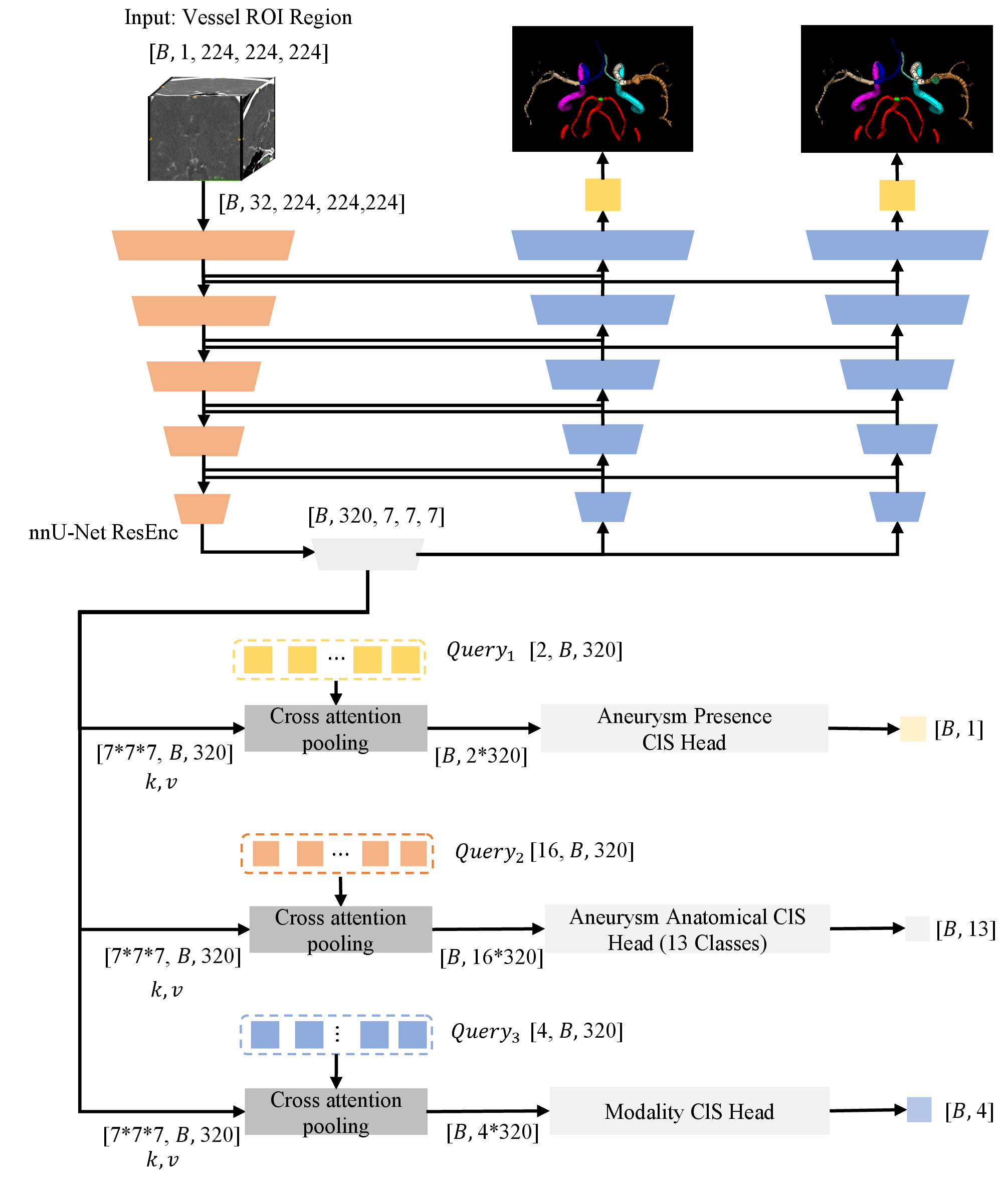 Figure 2: Stage 2 multi-task framework. Dual segmentation decoders produce vessel and aneurysm location masks; three classification heads predict modality, aneurysm presence, and location.