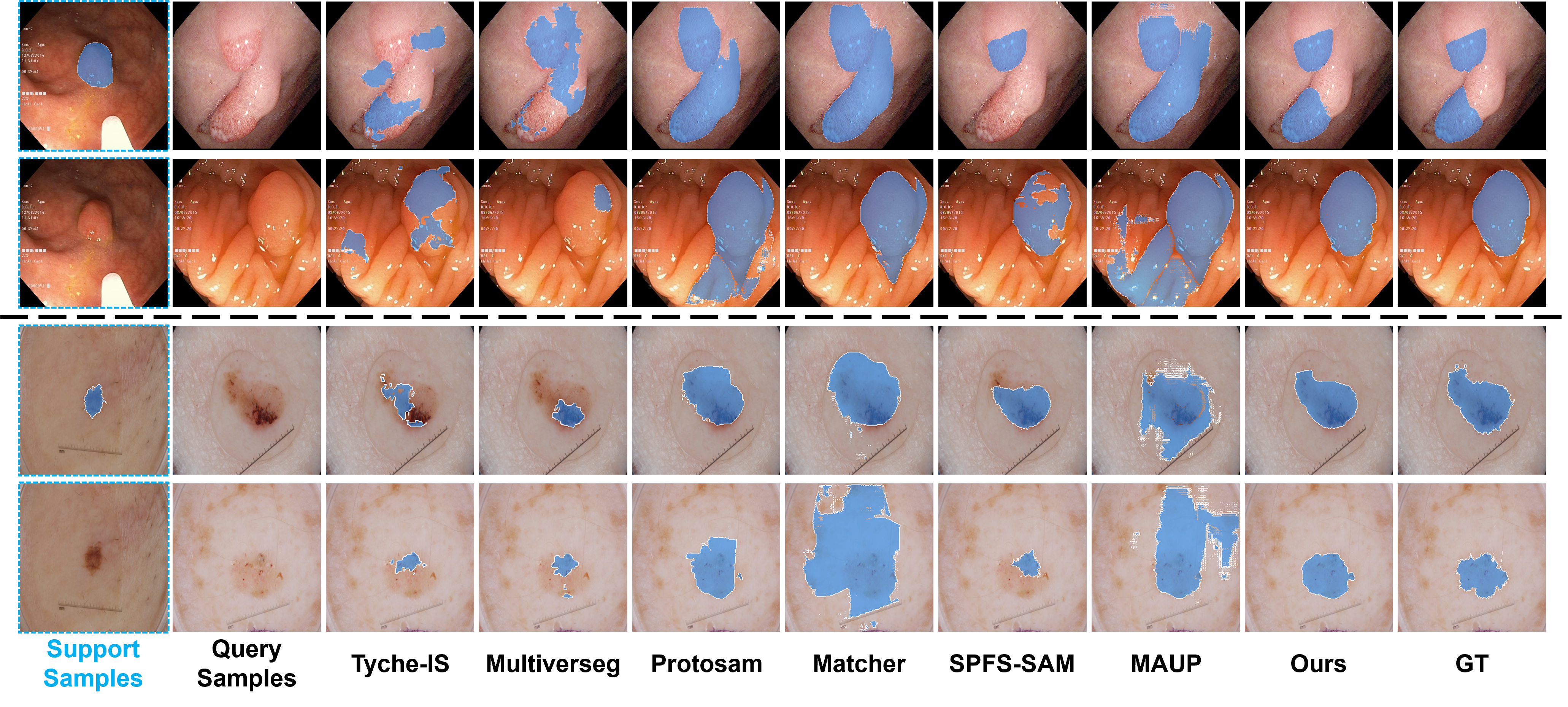 Figure 2: Visualization of 1-shot results on Kvasir-SEG (top) and ISIC-2017 (bottom).