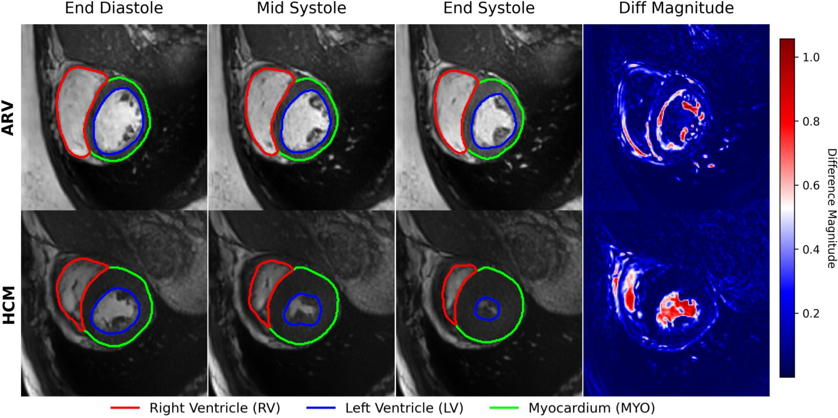 Figure 2: Example of synthetic volumes and segmentation across pathological classes.