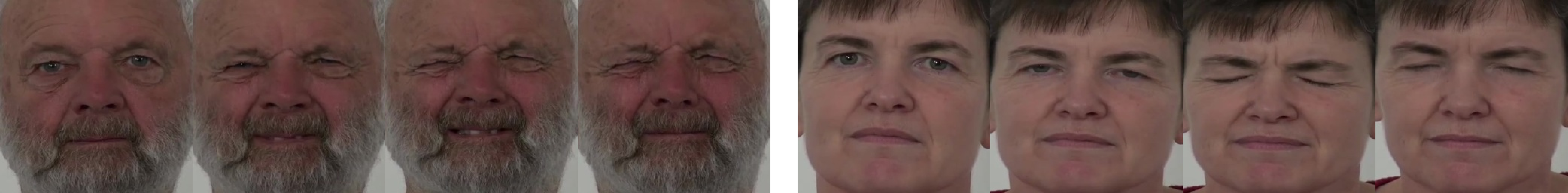 Figure 1: Same severity level, different evidence patterns for ‘Squeeze eyes’. Both cases are assigned the same rating (level 2), but are supported by different facial motor evidence. The left case shows strong eyelid tightening with lips parted, whereas the right case exhibits milder tightening with minimal lower-face involvement.