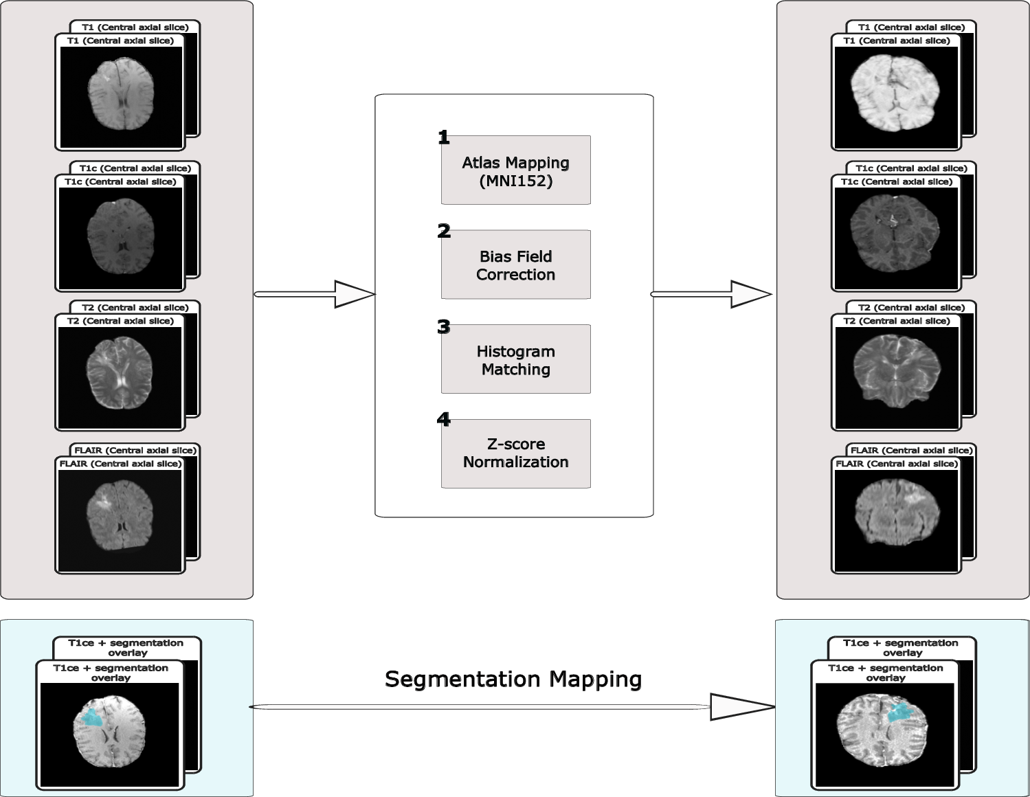 Figure 8: Preprocessing pipeline applied to the raw MRI data. The four MRI modalities undergo atlas registration to MNI152 space, N4 bias field correction, histogram matching, and z-score normalization. The HD-GLIO-AUTO segmentation mask is mapped to the same template space using the transformation estimated from the corresponding MRI, with nearest-neighbor interpolation used to preserve discrete label values.