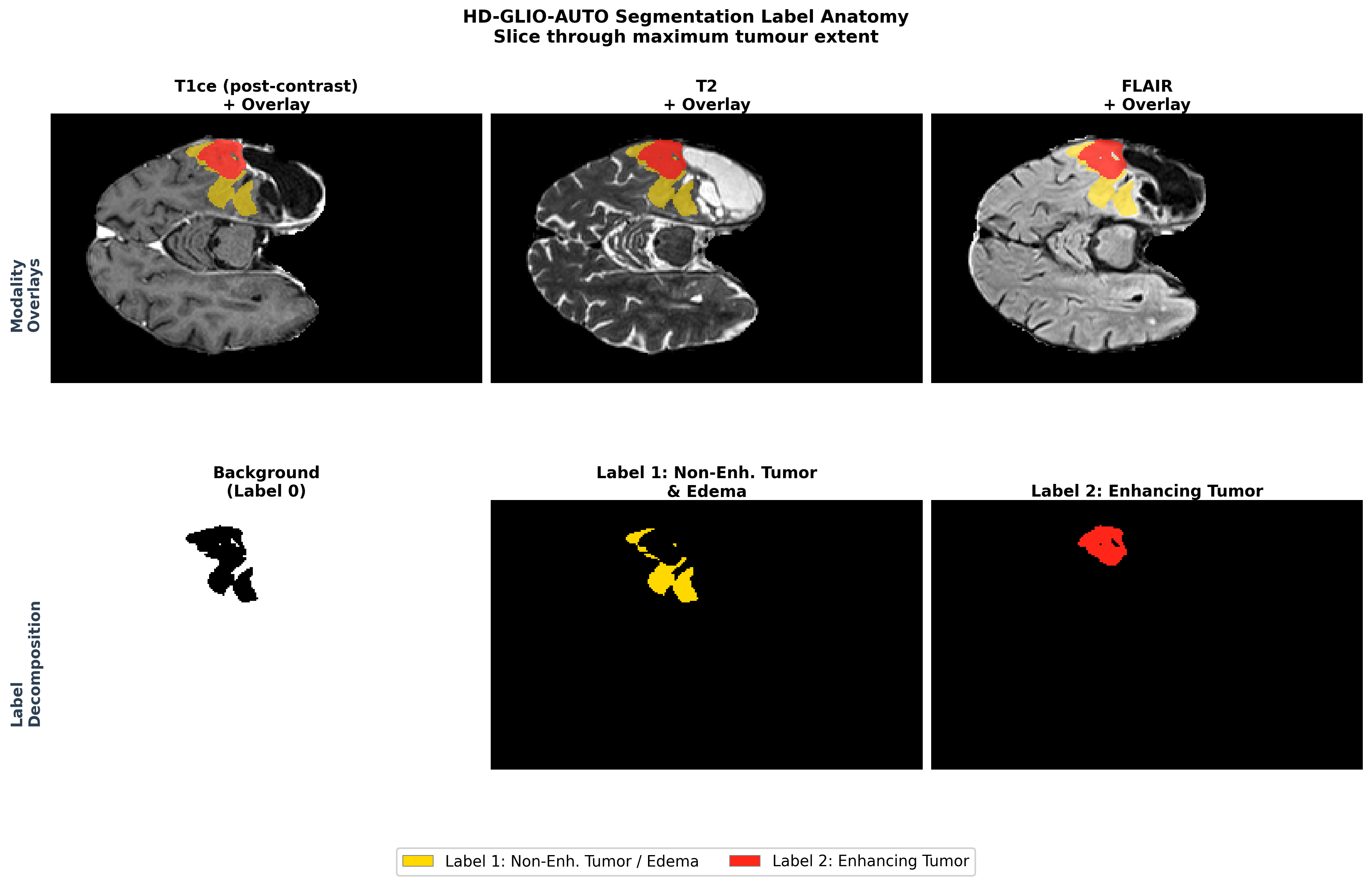 Figure 2: Representative segmentation case from LUMIERE. Top row: three MRI modalities with the HD-GLIO-AUTO overlay. Bottom row: non-enhancing (yellow) and enhancing (red) tumor labels in isolation. These regions are used to compute volumetric concepts for Trace.