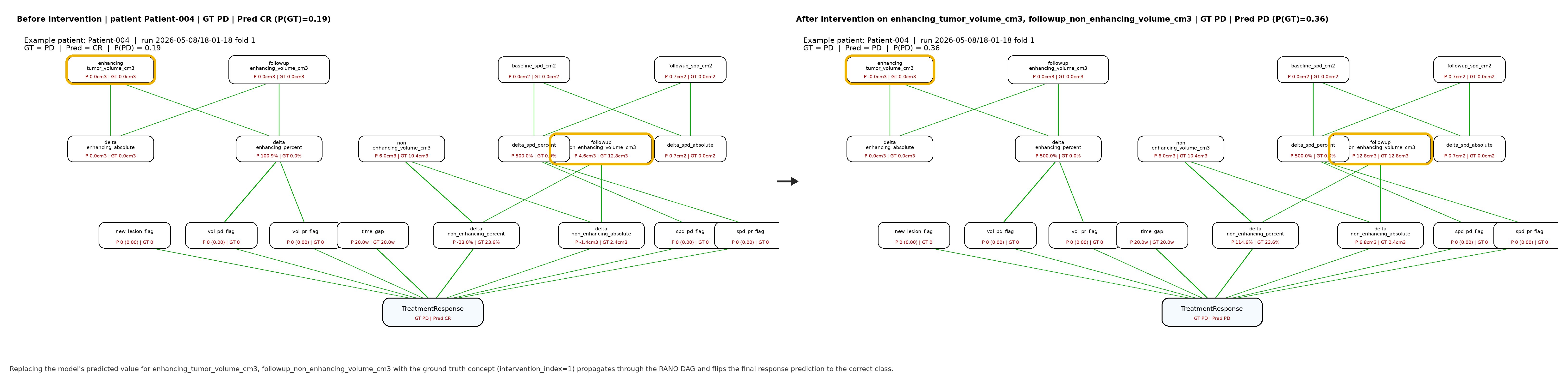 Figure 7: Concept-intervention walkthrough on a misclassified case (Patient-004, validation fold 1). Left: default forward pass; the model predicts CR while the ground-truth label is PD. Right: same input with \mathrm{intervention\_index}=1 on enhancing_tumor_volume_cm3 and followup_non_enhancing_volume_cm3 (yellow outlines). The corrected concept values propagate deterministically along the RANO chain (\Delta\%\toflags\toresponse) and the prediction flips to the correct PD class. No retraining or gradient step is performed.