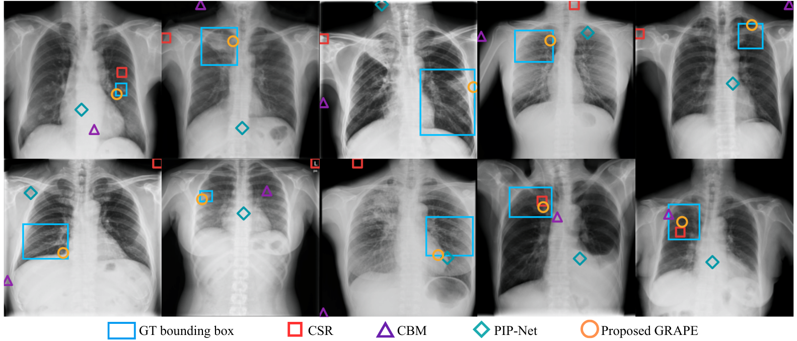 Figure 2: Pointing Game on TBX11K chest X-rays (Active TB concept). Each dot shows the max-activation point of a method; only GRAPE (yellow circle) consistently localizes the lesion inside the ground-truth bounding box (cyan). Other methods scatter to irrelevant regions.