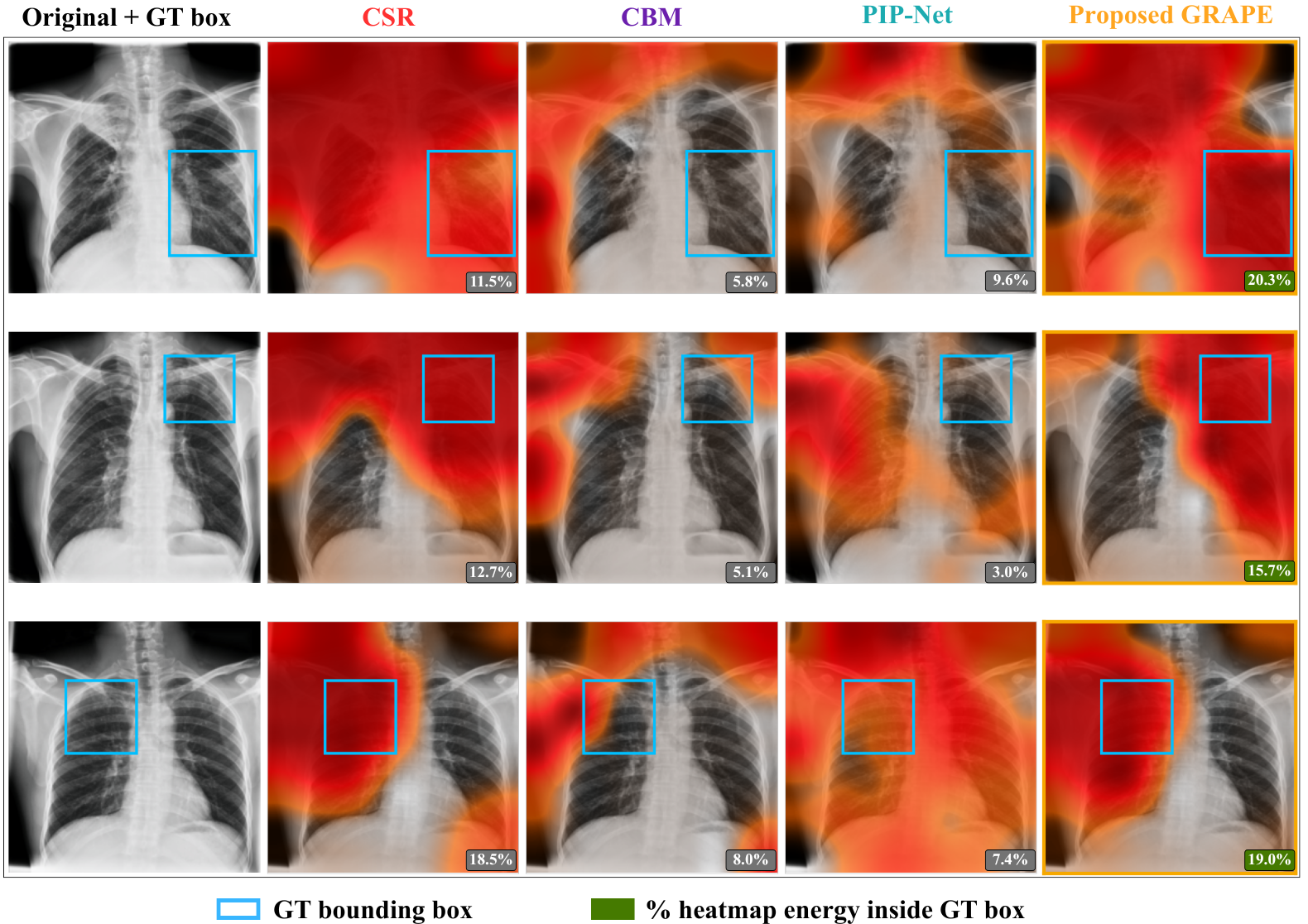 Figure 3: Prototype similarity maps for CSR Baseline, CBM, PIP-Net, and GRAPE across three representative Active TB examples. Heatmaps are overlaid on the input X-rays; cyan boxes denote ground-truth lesion annotations; percentage badges report the fraction of total heatmap energy inside the ground-truth box. Aggregate box-energy statistics are consistent with the Pointing Game results in Table ¿tbl:tab:tbx11k?.