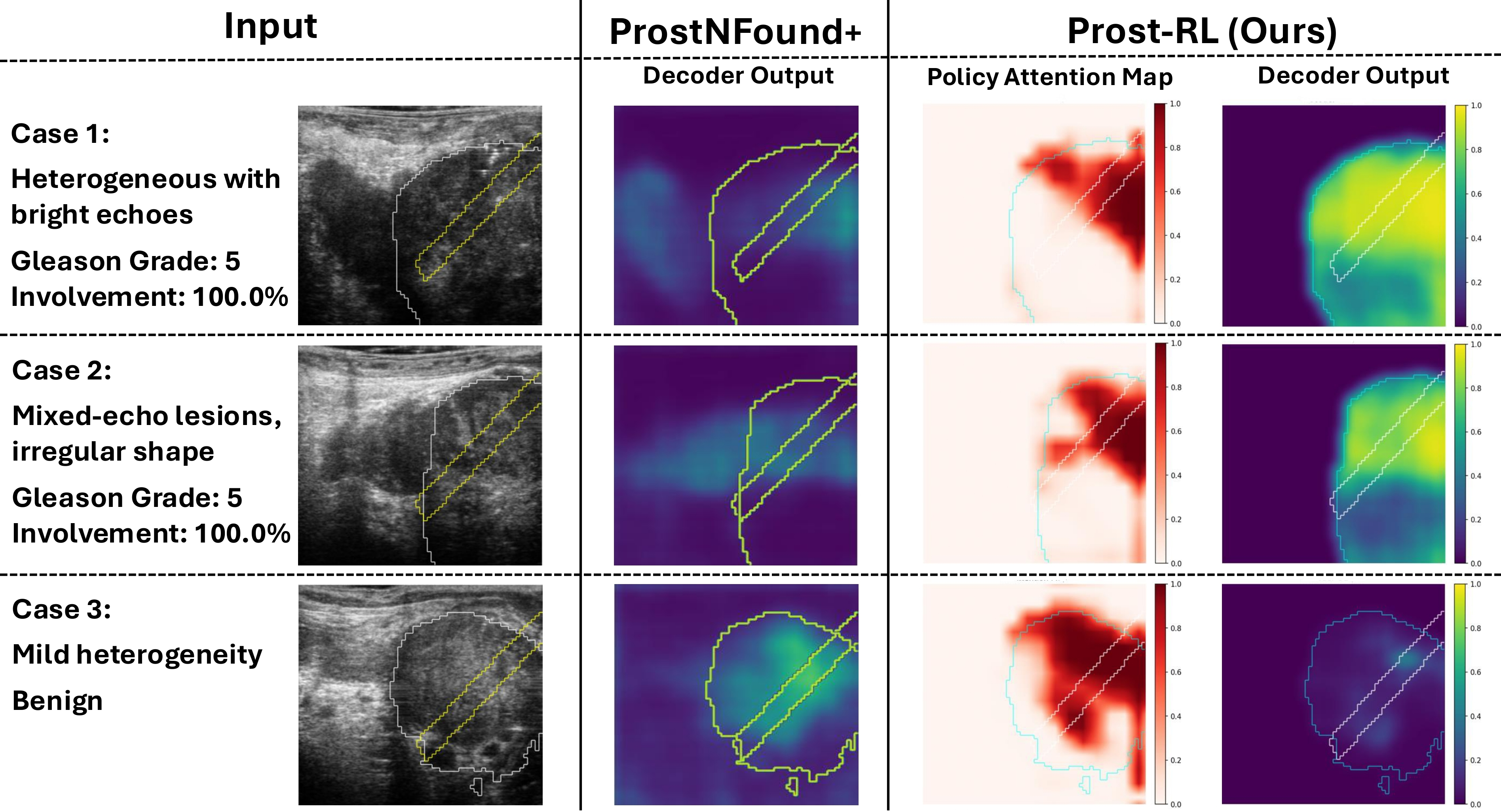 Figure 3: Example heatmaps generated by ProstRL and ProstNFound+, shown alongside ground‑truth labels and radiologist annotations.