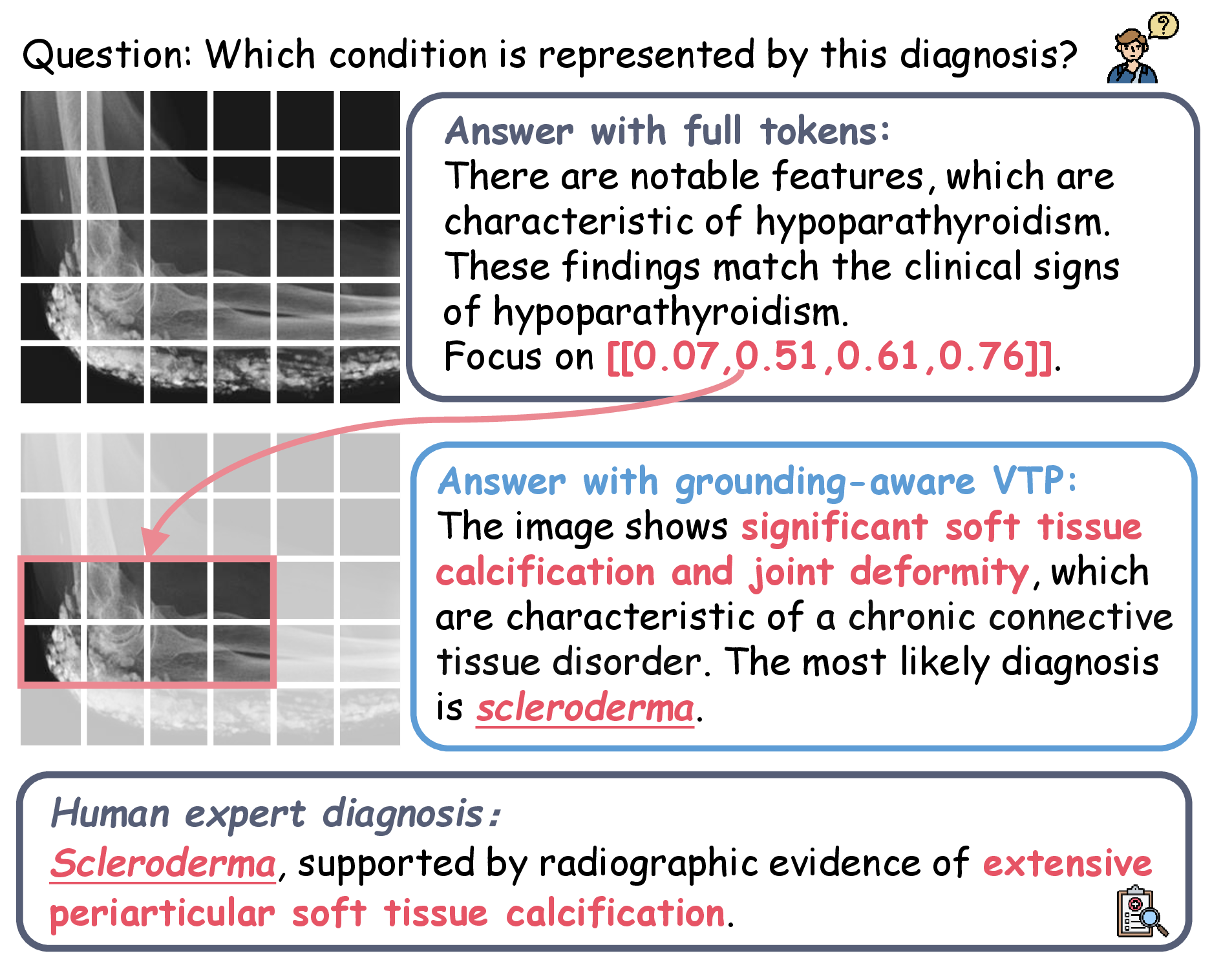 Figure 1: Illustration of grounding-aware VTP. By focusing its reasoning on grounded tokens, the model correctly diagnoses scleroderma, consistent with the human expert assessment.