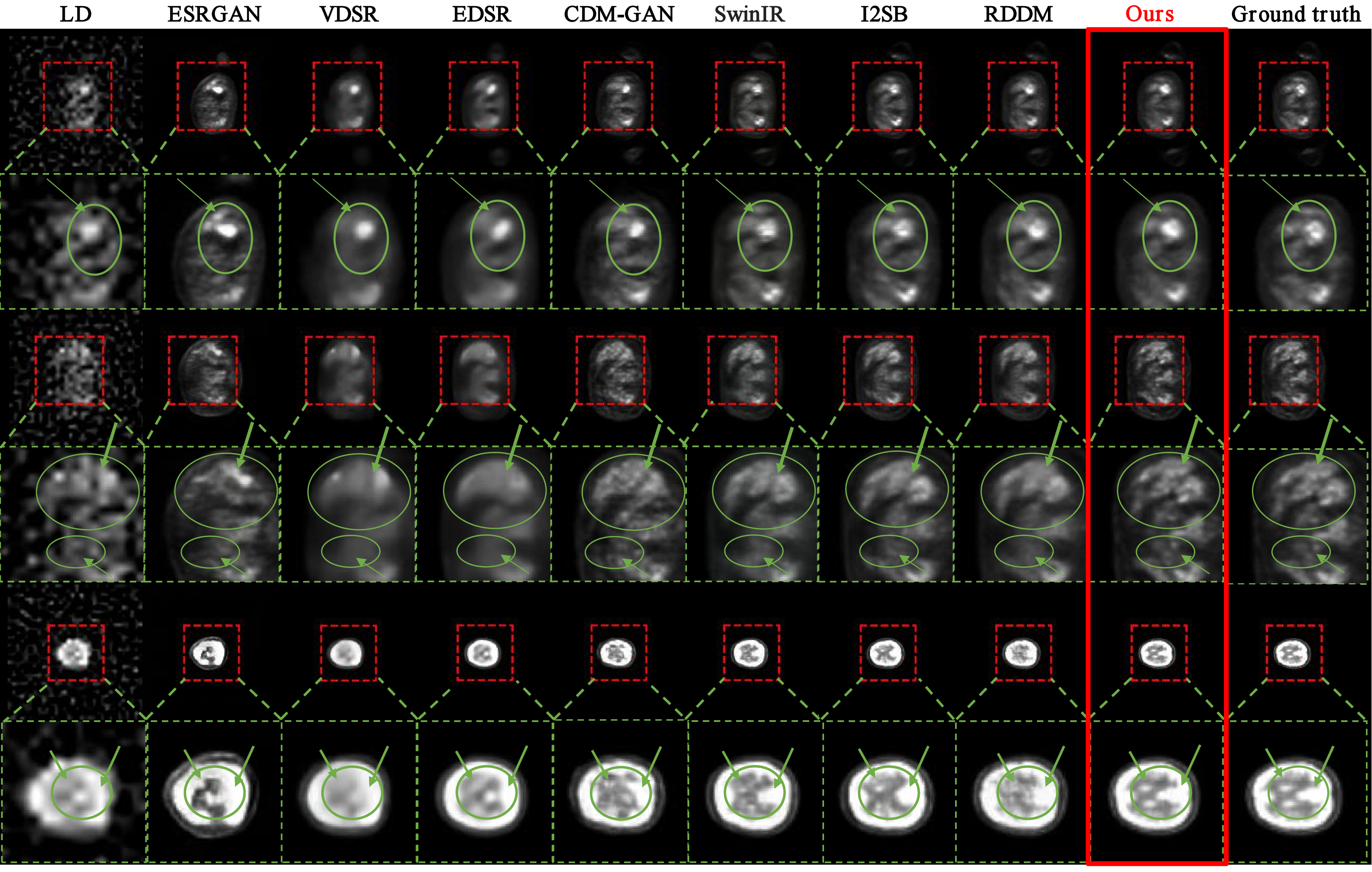 Figure 5: Representative HECKTOR PET denoising case. Columns show the LD PET input, outputs from compared methods, AnF-DiffPET, and the ground truth HD PET image. For each case, the first row shows the full PET slice, and the second row shows the ROI zoom-in views corresponding to the dashed box in the first row. Green arrows and circles highlight representative uptake structures and local anatomical details for visual comparison.