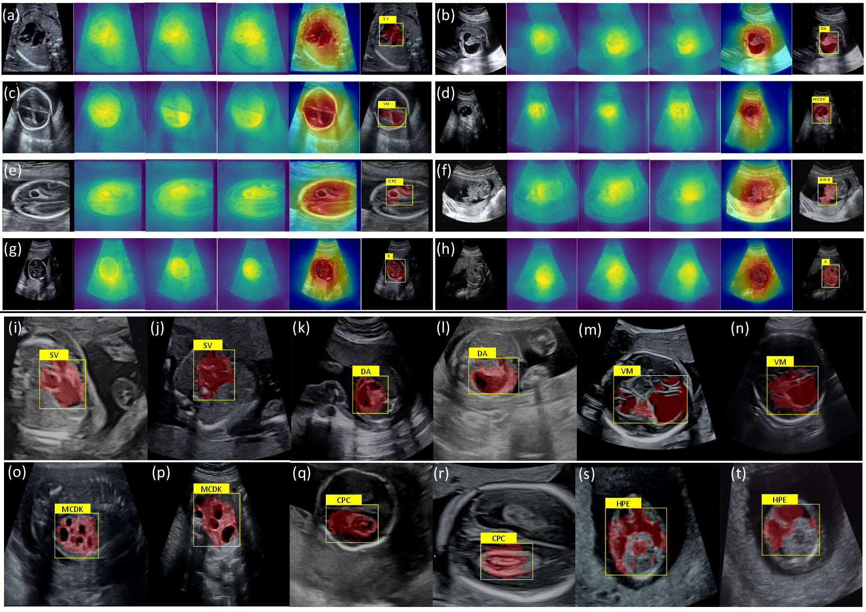 Figure 3: Visualization of typical cases. (a)-(h) show representative examples. From left to right: the query image, similarity maps of three prototypes, the anomaly map, and the predicted anomaly region with category label. (i)-(t) shows additional cases.