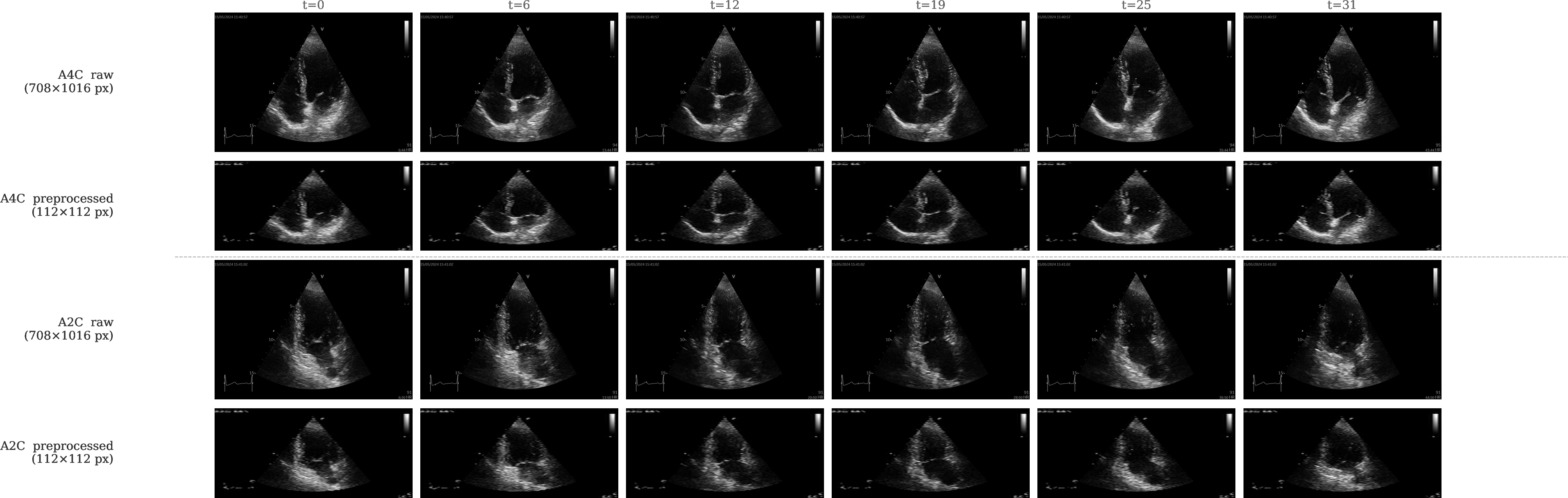 Figure 2: Representative echocardiography frames from a single patient (ECHORISK_0001, baseline T_1 visit). Each row shows six of 32 evenly sampled frames spanning one full cardiac cycle. Top pair: apical four-chamber (A4C) view. Bottom pair: apical two-chamber (A2C) view. Within each pair, raw DICOM frames (native resolution, upper row) are shown alongside preprocessed frames (lower row) after resizing to 112\times112 pixels and per-clip z-score normalisation. Note the aspect ratio change introduced by resizing non-square native frames to the fixed spatial resolution required by the Kinetics-400 pretrained backbone. Scanner text overlays and acquisition artefacts are retained in the released DICOMs.