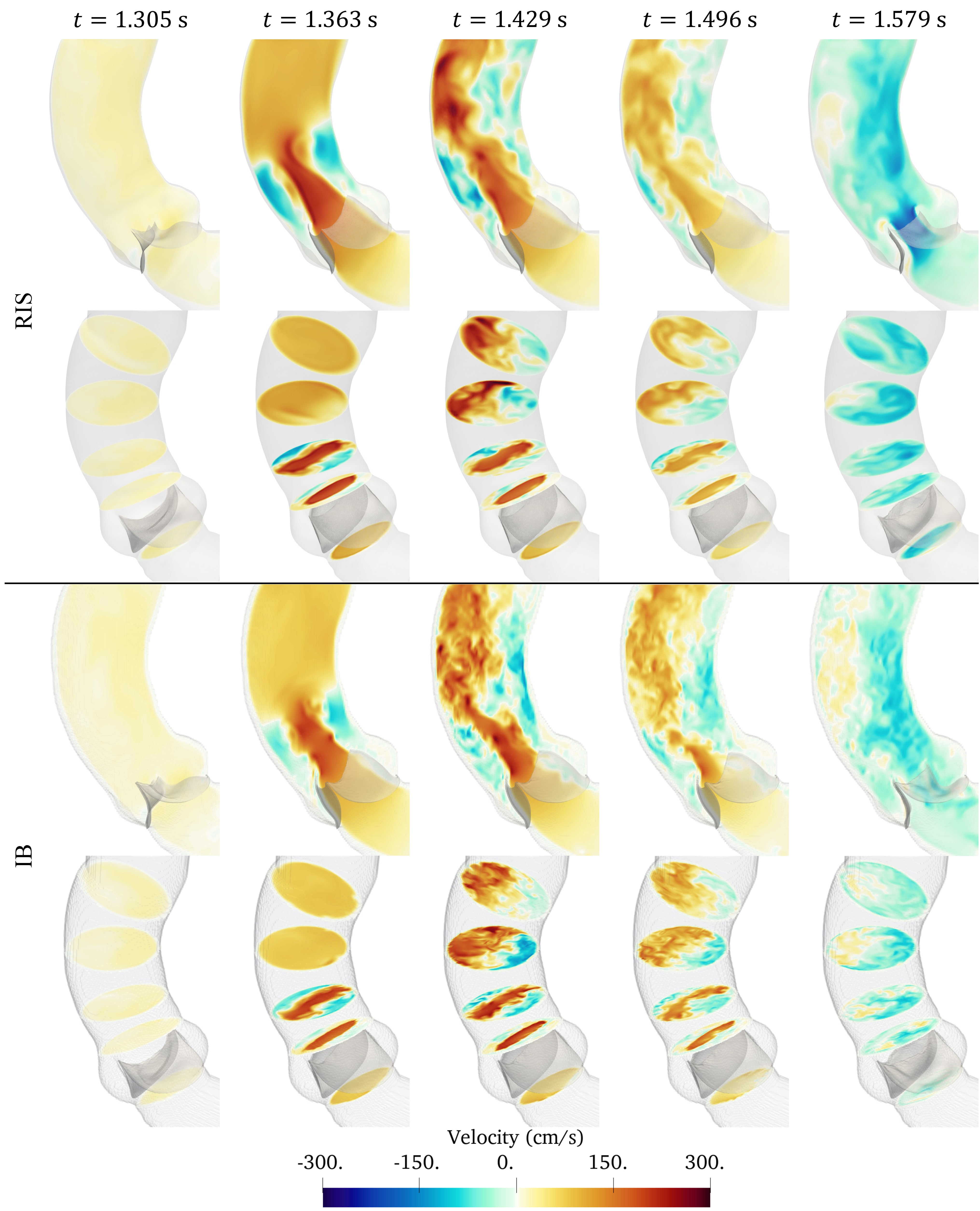 Figure 10: Comparison of the vertical velocity field and bulk flow structures in the bicuspid valve simulations obtained with the RIS and IB methods.