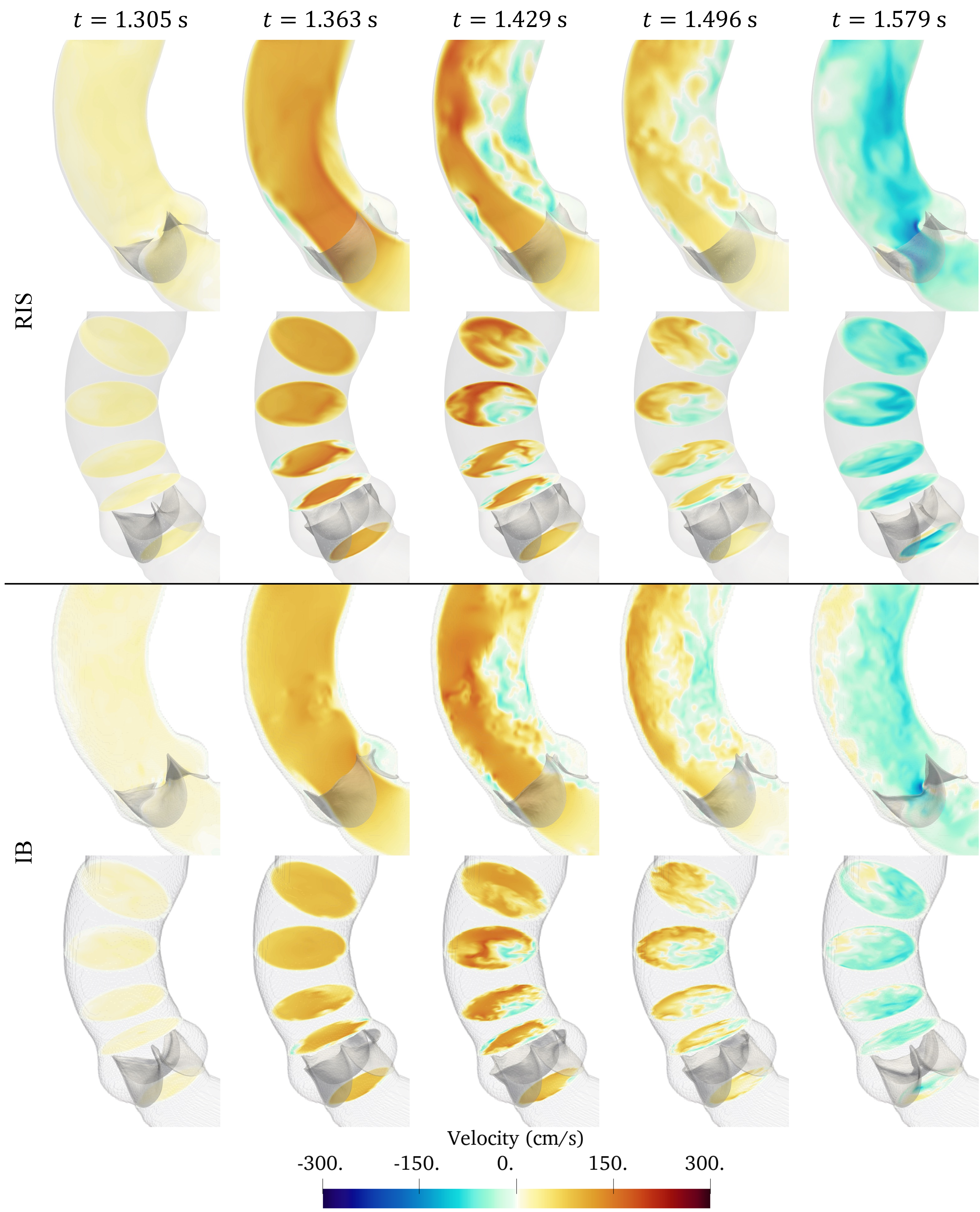 Figure 4: Comparison of the vertical velocity component and bulk flow structures in the aortic valve simulations obtained with the RIS and IB methods during the second cardiac cycle. The slices shown in the second row are normal to the artery axis, and those located immediately below and above the valve are used to calculate the transvalvular pressure gradient.