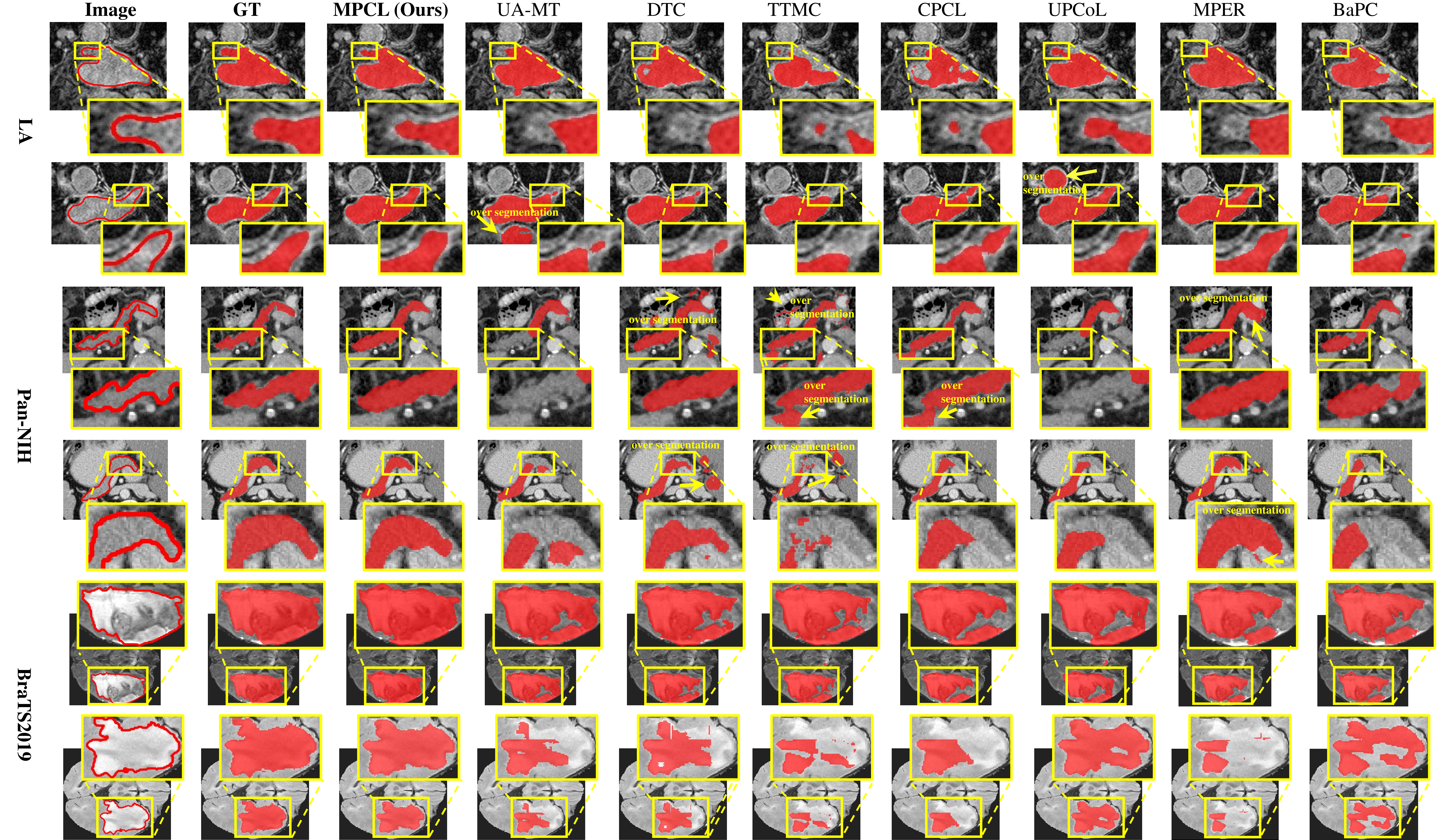 Figure 6: Visualization comparison indicates more precise segmentation of our MPCL on examples of 2D slices on LA, Pan-NIH and BraTS2019 dataset under 5% labeled data setting. Most other methods struggle to process heterogeneous foreground and to distinguish similar foreground and background, thus causing under-segmentation in the foreground and over-segmentation (yellow arrow) in the background.