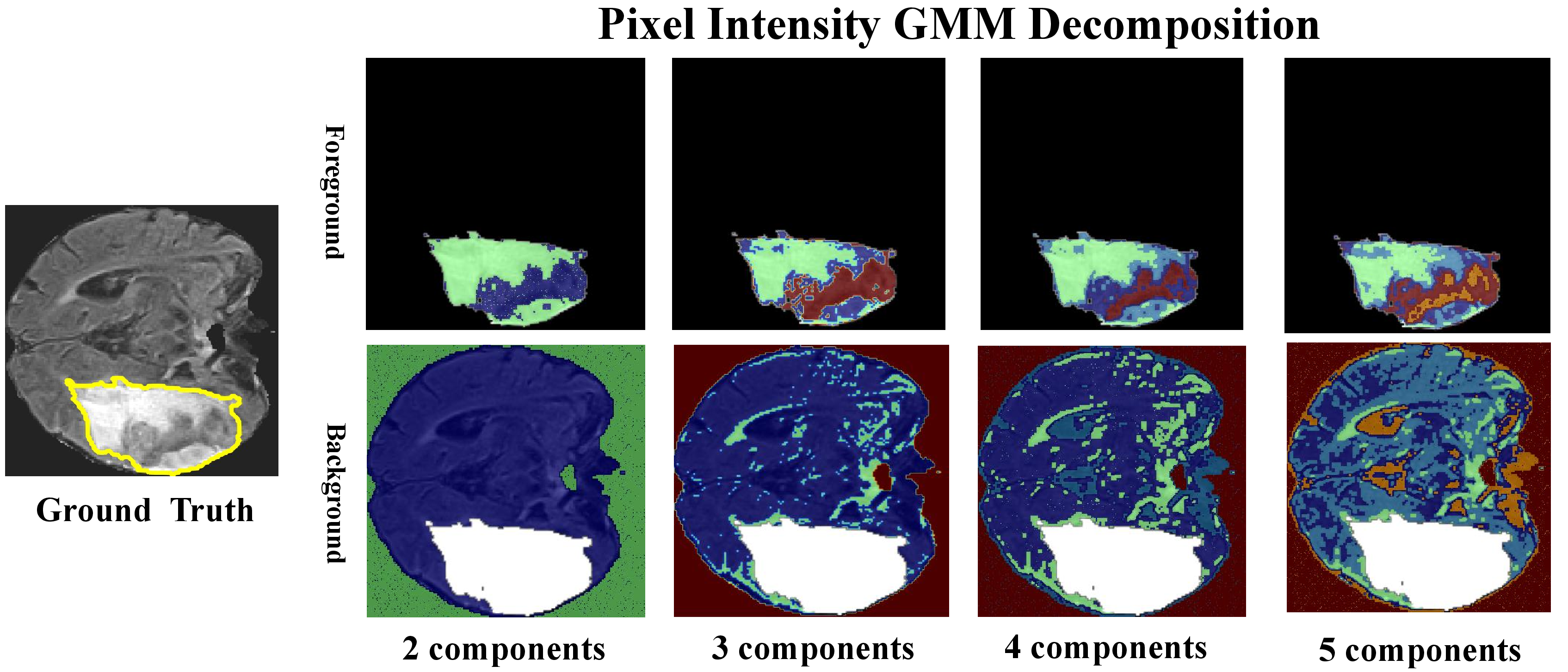 Figure 7: GMM decomposition of the intensity distribution under different component number settings reveals that increasing the component number beyond 3 leads to redundant subdivision within existing intensity subregions, where individual components lose their representativeness of distinct intensity-based patterns.