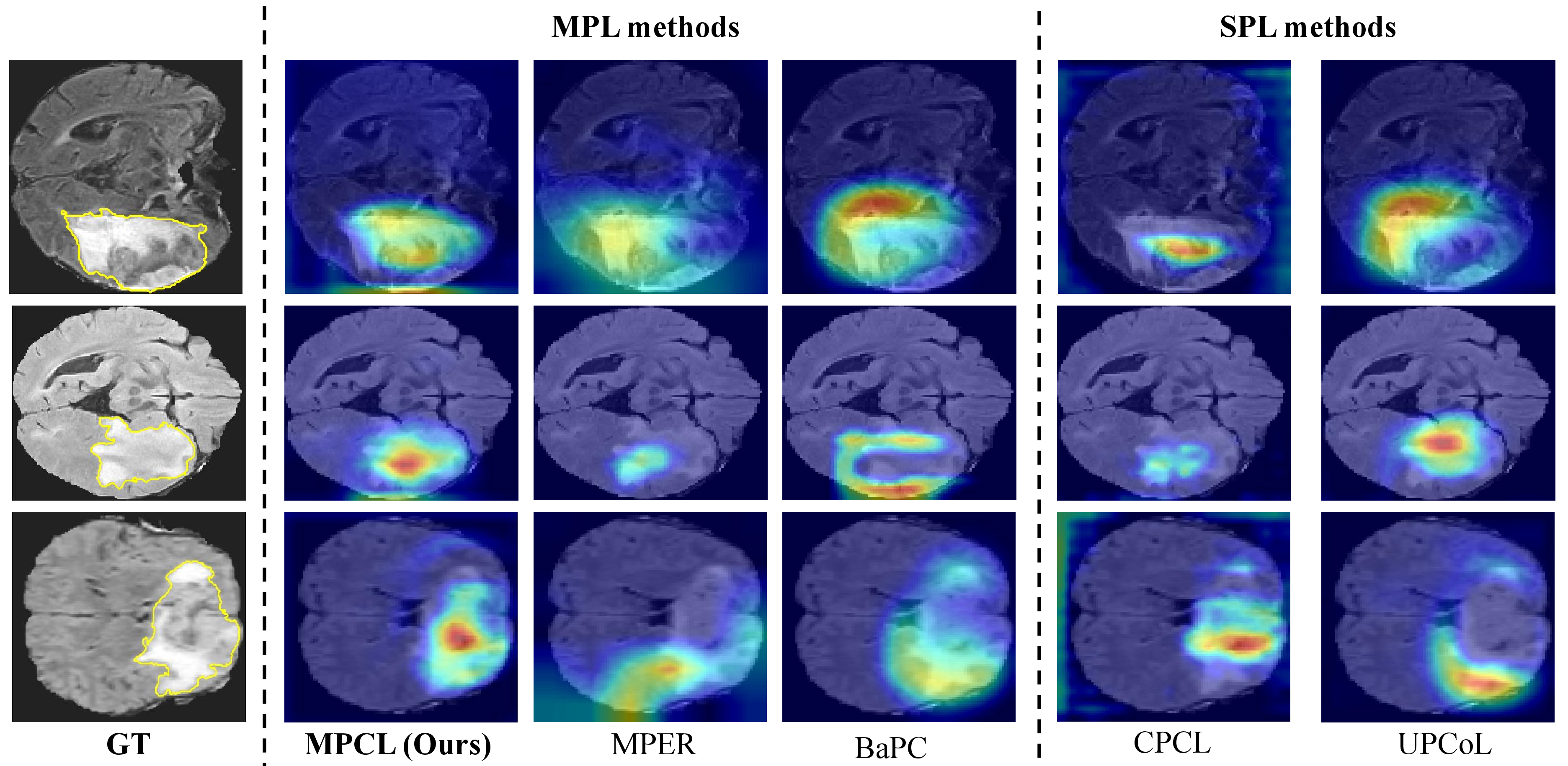 Figure 9: Grad-CAM visualization comparison between our MPCL and other PL SSMIS methods (including MPL methods MPER [10] and BaPC [9]; SPL methods CPCL [8] and UPCoL [7]) on BraTS2019 demonstrates that MPCL attends to more diverse intra-class heterogeneity structures while other MPL and SPL methods only capture partial structures. Ground truth is shown in yellow contours in the first column.