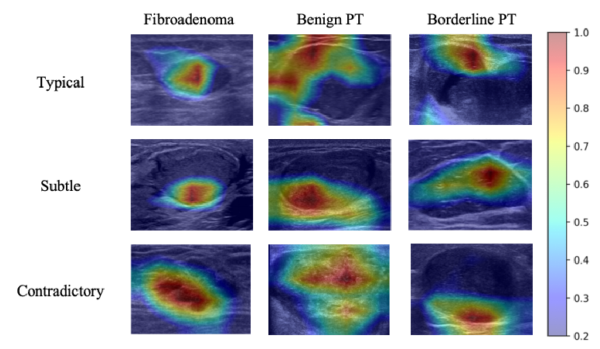 Figure 3: Representative Grad-CAM images of breast fibroadenoma (FA) and phyllodes tumor (PT). Red regions indicate areas that contribute more strongly to the model prediction, while blue regions indicate regions with lower contribution.