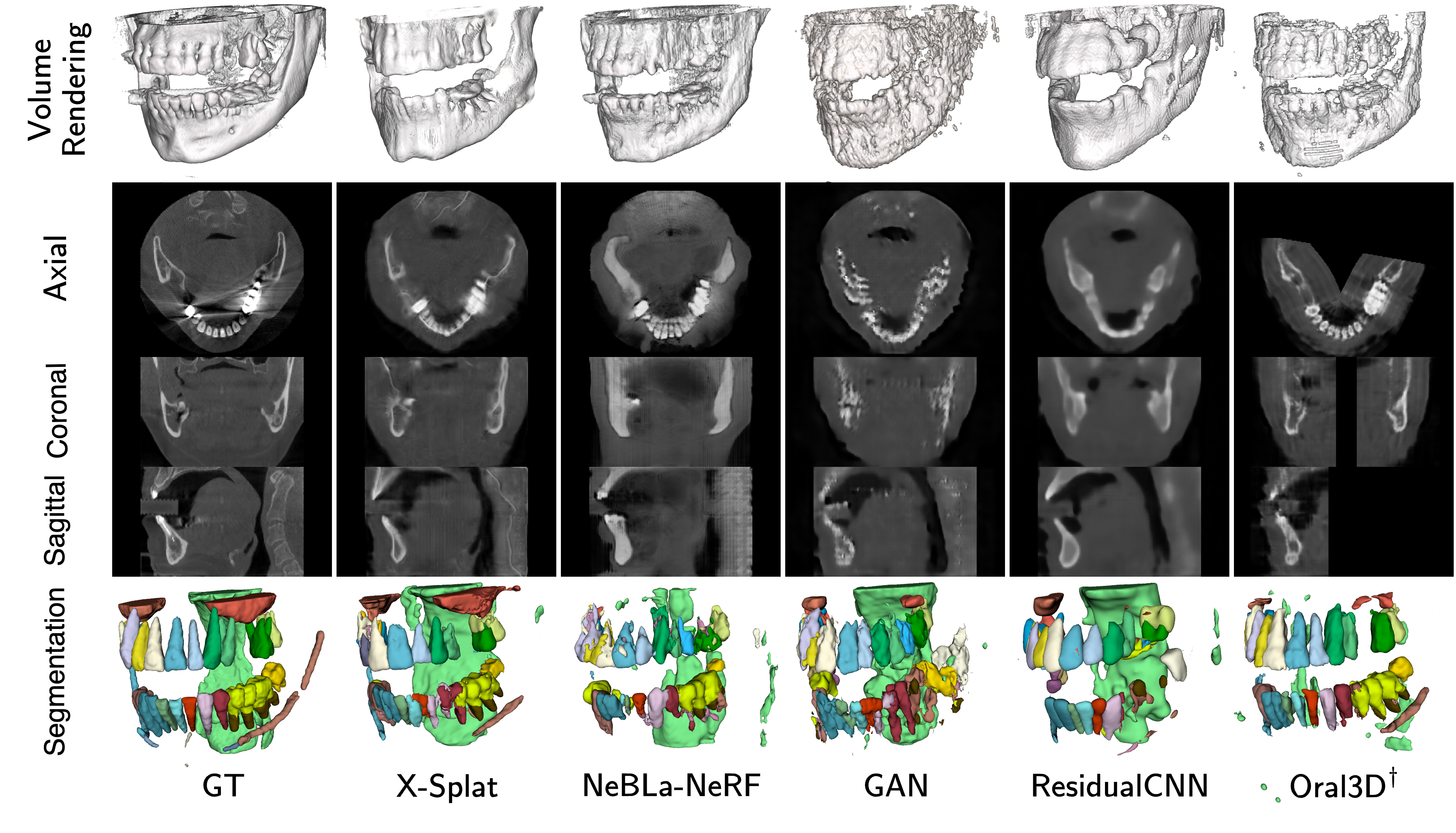 Figure 4: Qualitative comparison of 3D CBCT generation from a single panoramic X-ray. From top: volume rendering, axial, coronal, and sagittal cross-sections, and 3D segmentation. X-Splat recovers cortical and trabecular bone, maxillary sinuses, and the MC without hallucinating teeth in edentulous regions; sharp cortical boundaries are visible as bright shells in the cross-sections. Maxilla and mandible labels are hidden in the segmentation row to reveal MC and sinus structures. ^\daggerOral-3D uses ground-truth arch geometry and reconstructs only the dental arch sub-volume; surrounding anatomy is absent.