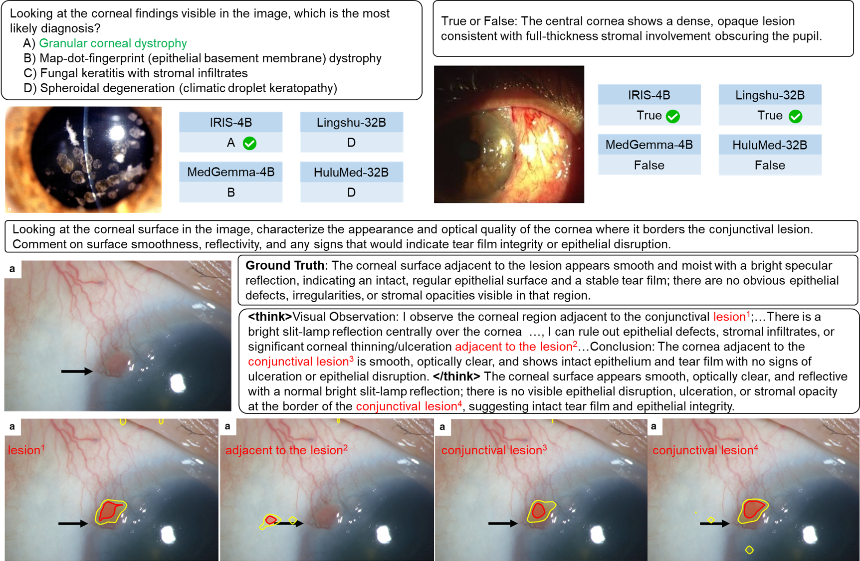Figure 3: Qualitative evaluation of IRIS-4B. Top: Accurate predictions on complex objective tasks, outperforming substantially larger medical baselines. Bottom: Demonstration of transparent reasoning and visual grounding. IRIS-4B articulates its logic via a <think> block and visually anchors generated clinical terms (red text) to localized pathological regions (attention contours: >25\% yellow, >50\% red).