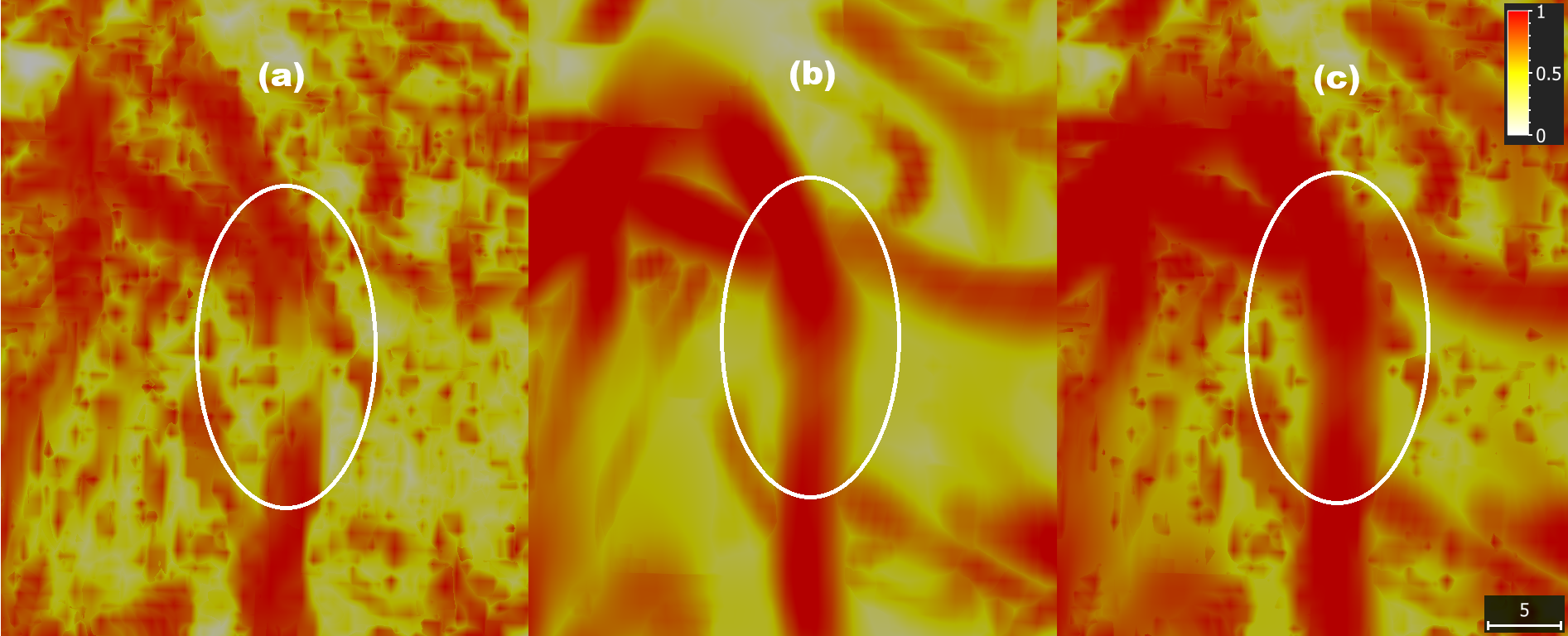 Figure 3: Close-up on a medium pulmonary vessel. (a) Under Frangi, the vessel is disconnected, reflecting the filter’s difficulty with larger, locally non-ideal tubular structures. (b) Under Sato, the same vessel appears as a continuous tube. (c) In the fused map, the gaps left by Frangi are filled by the Sato response, restoring a single uninterrupted vessel.