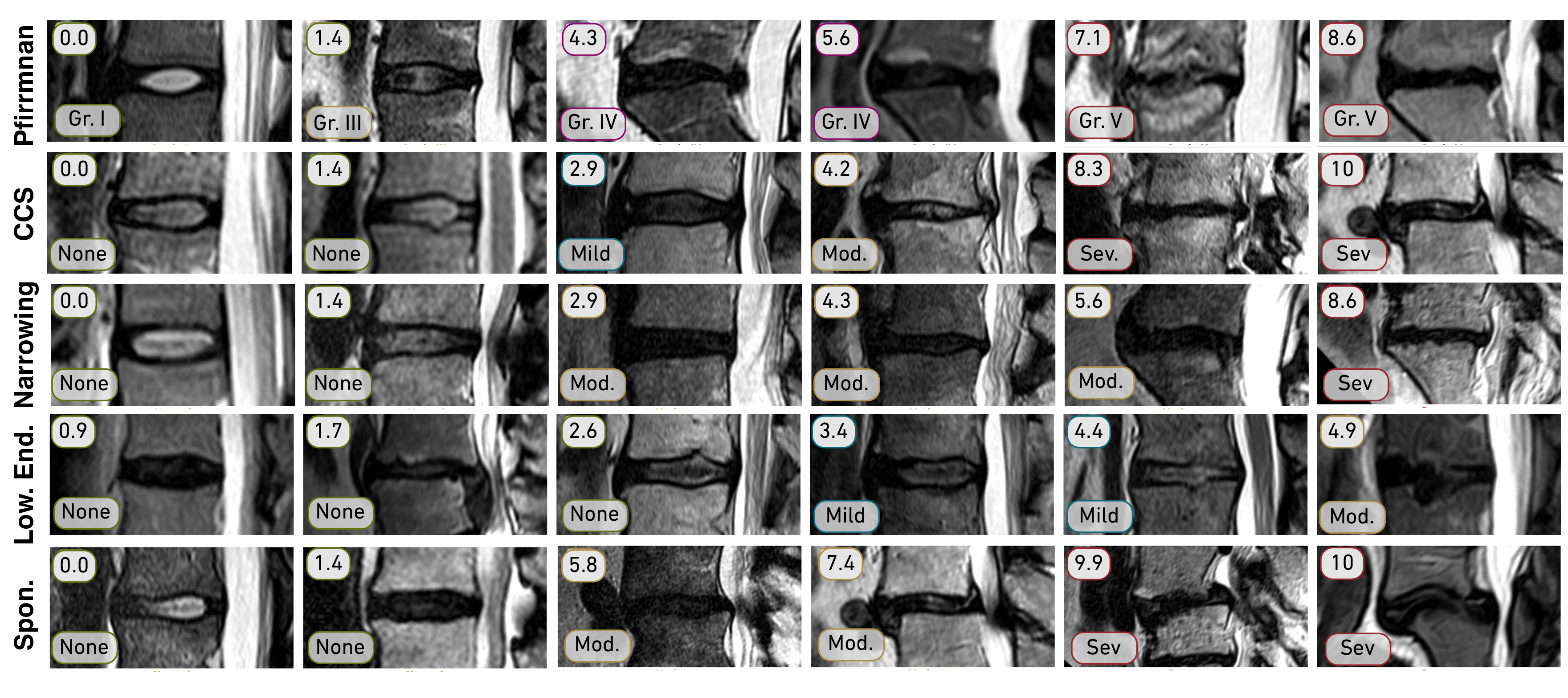 Figure 2: Example visualization of severity ranking for the pathology scores. IVD volumes for Pfirrmann, central canal stenosis (CCS), Narrowing, and Lower Endplate defects (Low.End) and Spondylolisthesis, ordered by predicted score s \in[0,10] (top) with ground-truth ordinal grades (bottom). Note how the severity progressively increases with score. For example, for CCS, “None” cases (0.0 vs.) differentiate normal from subtle central canal compression, while “Severe” cases (8.3\to​10) capture progressive cord impingement