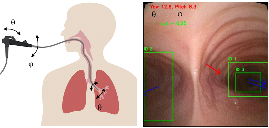 Figure 1: Vanishing-point geometry in bronchoscopy. The bronchoscope tip is steered by twist \phi and bend \theta, but in tubular airways these motions produce little parallax and camera singularities that make direct orientation recovery unreliable. Distal lumen entrances, however, act as portals aligned with the true bronchial axis. By back-projecting their centers to 3D rays (blue arrows) and averaging them, we obtain a stable forward heading (red arrow) that serves as a geometry-aware orientation prior even when classical VO cues are weak or absent.