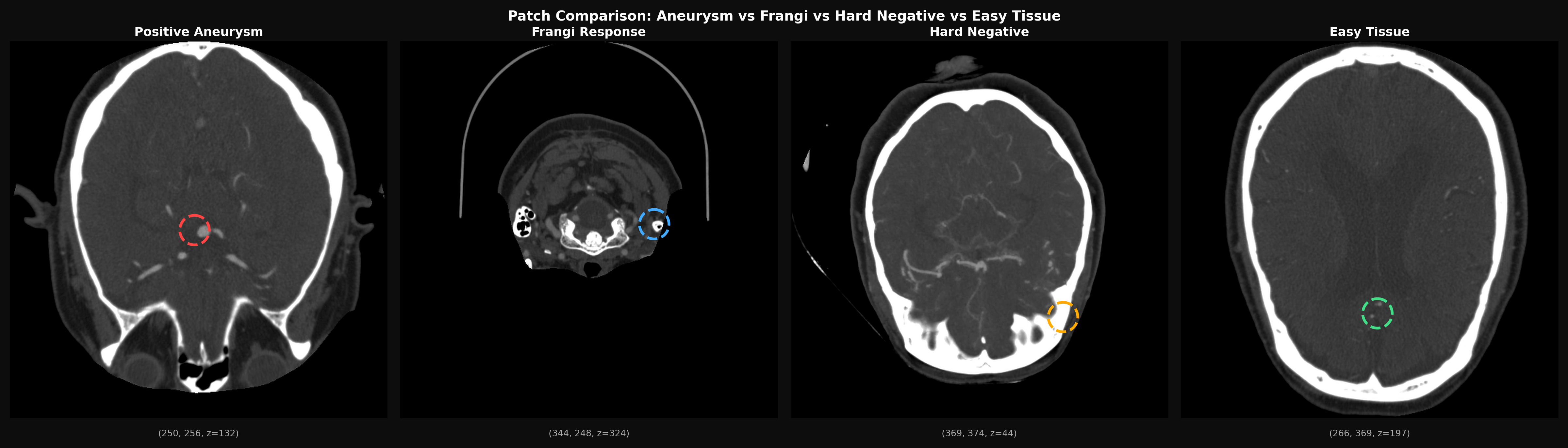 Figure 4: Representative examples of extracted CTA patches across classes. From left to right: (i) aneurysm-positive patch, (ii) Frangi-mined bifurcation candidate, (iii) hard vascular negative, and (iv) easy non-vascular tissue patch. Colored markers indicate patch centers used for extraction.