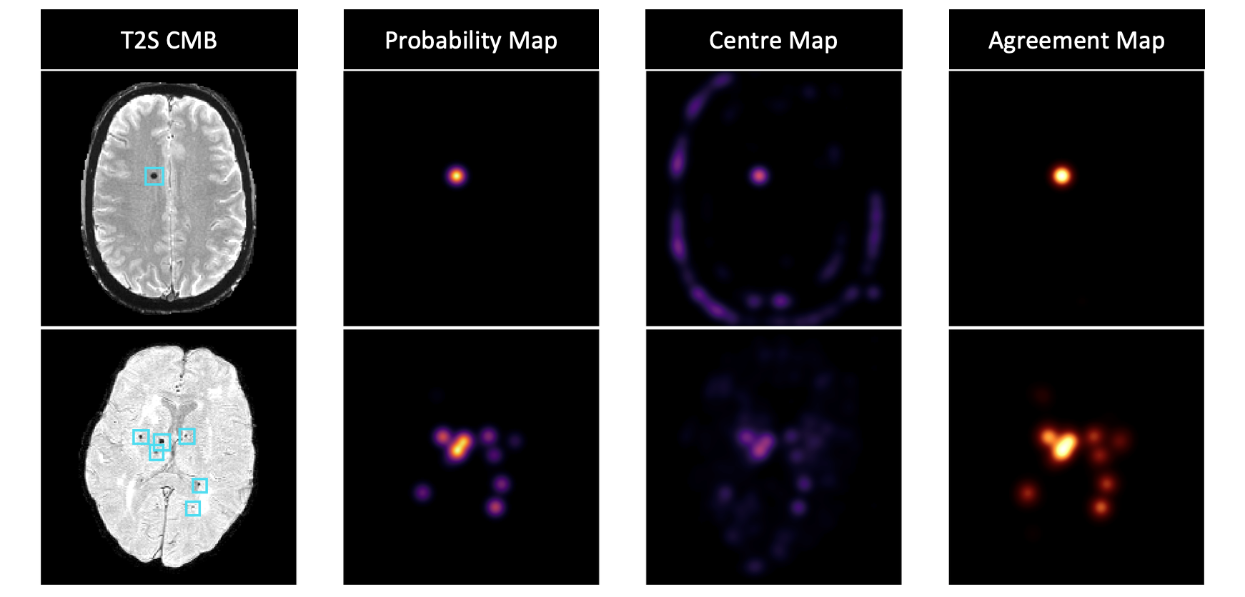 Figure 4: Grad-CAM visualisation of the centre-guided detector outputs, showing the T2^*-weighted slice, probability-map head, centre-map head, and agreement map. The centre-map head provides a complementary localisation signal around compact CMB candidates.